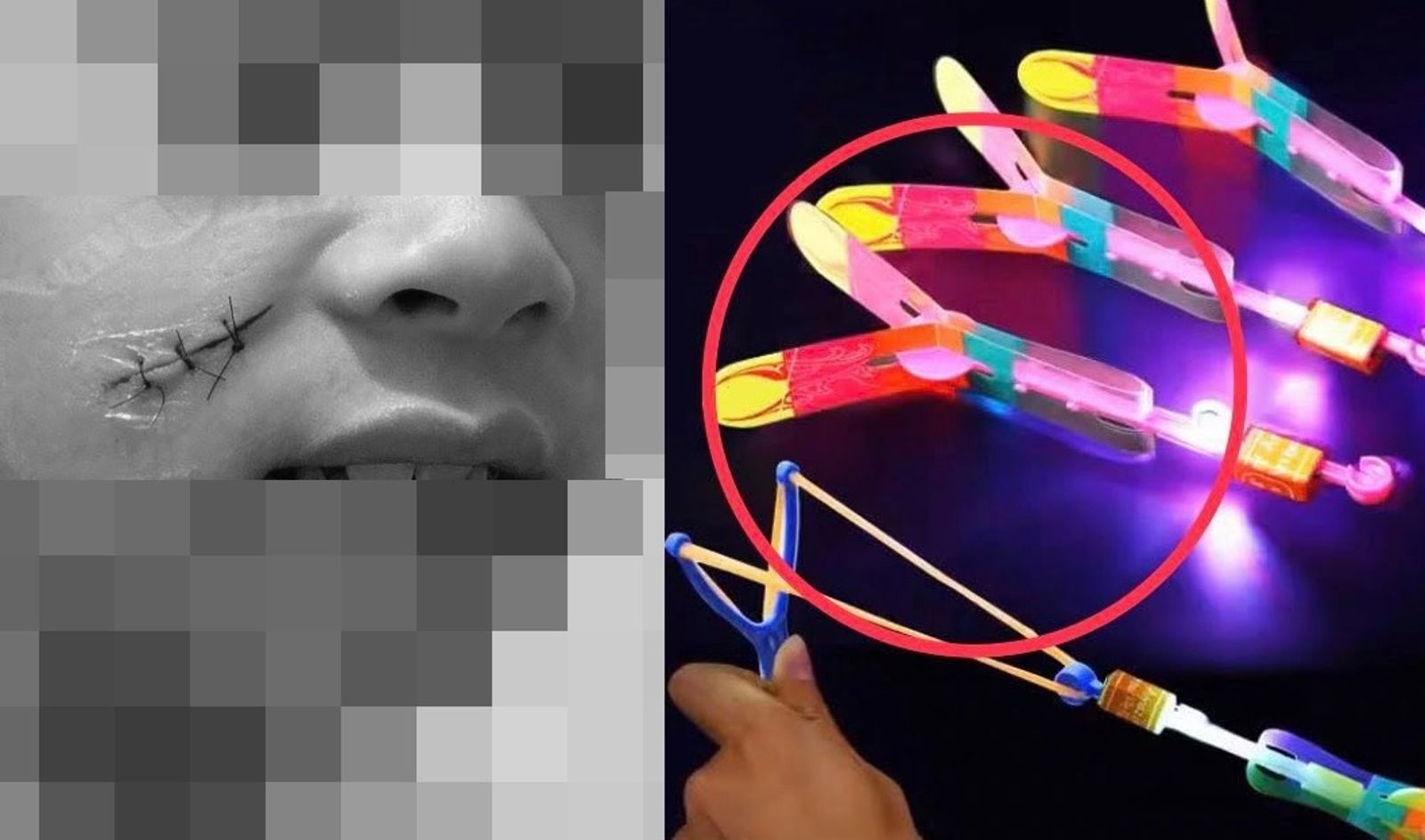 孩子玩彈弓飛鏢遭劃破臉縫三針　看兒慘狀心痛提醒「別再受害」