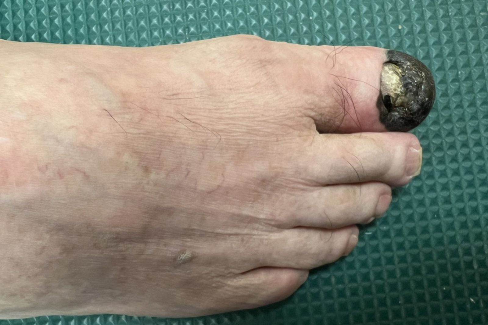 76歲翁「腳趾黑一塊」以為是瘀青!就診驚罹癌 皮膚7狀況要小心