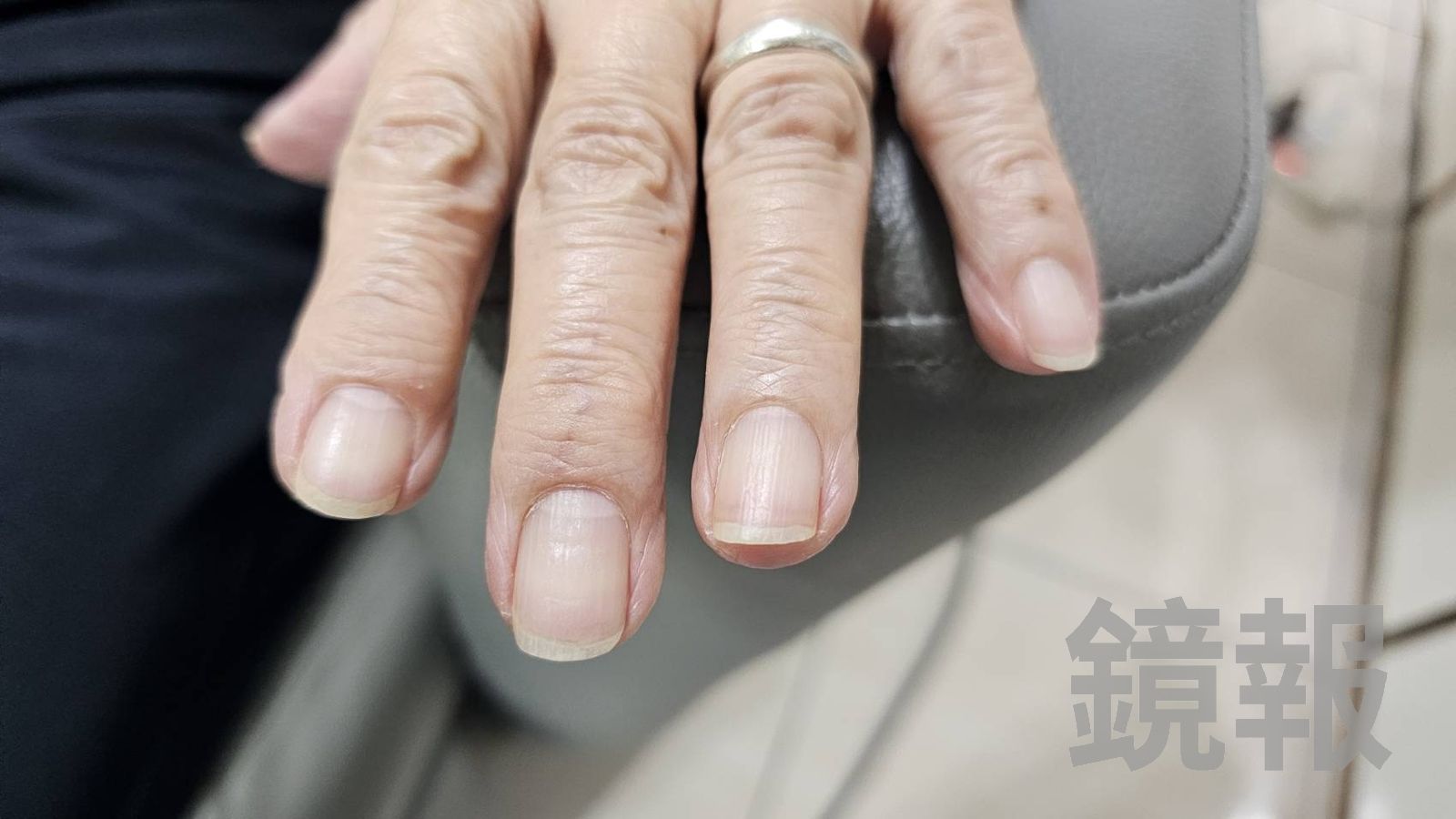 慢性病「從手就能看出來」　醫：光看指甲就能發現一堆病