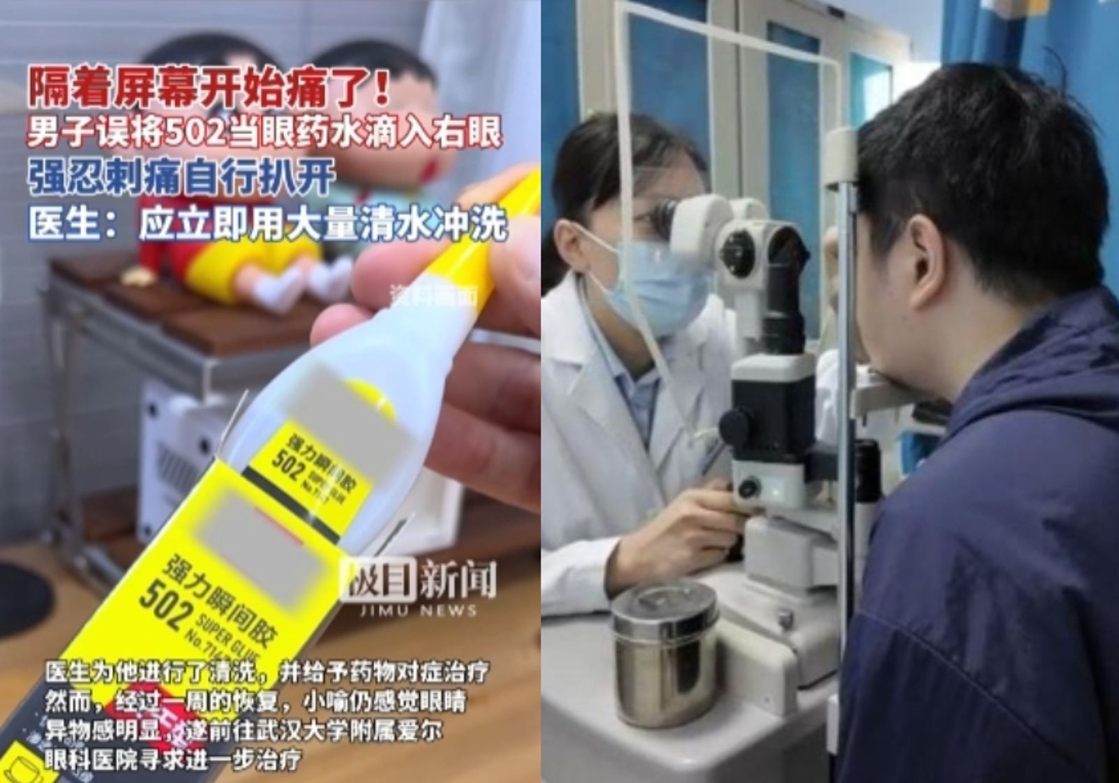 誤拿「502快乾膠水」當眼藥水！男子眼角膜灼傷「表面有大量圓點」