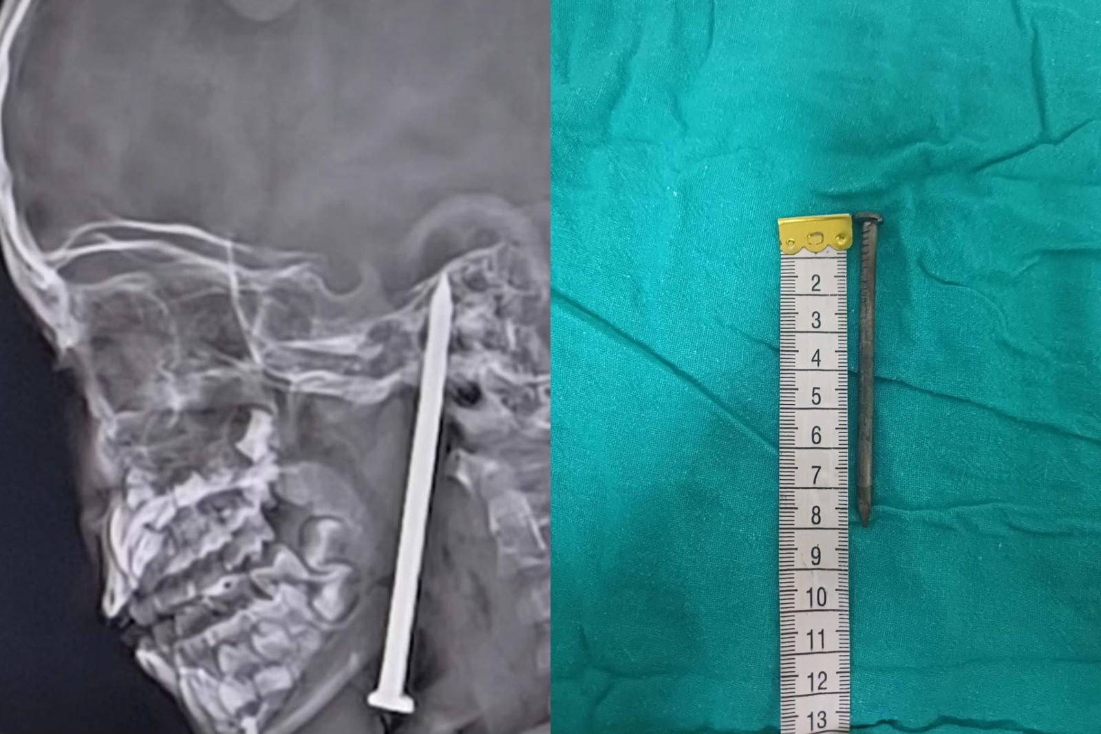 7歲童不小心跌倒!「8公分鐵釘」直插腦部 恐怖X光照曝光