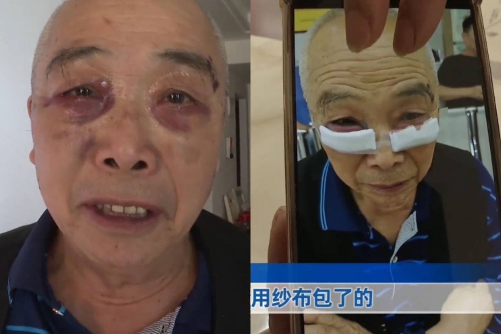 被恐嚇「不割眼袋會失明」！70多歲阿公嚇到做手術　女兒怒：眼睛都腫了