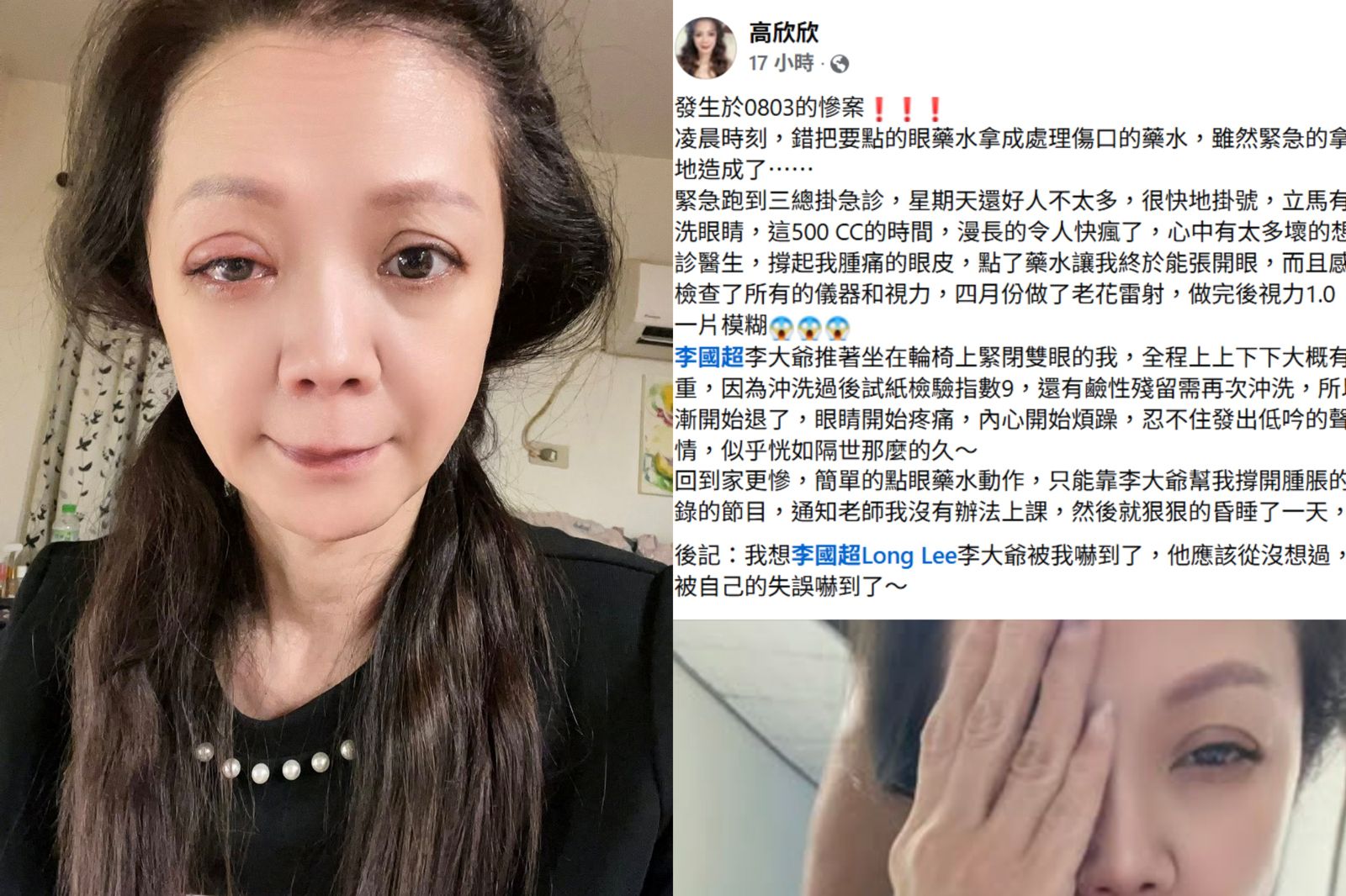 高欣欣誤點眼藥險失明　深夜發文停工休養