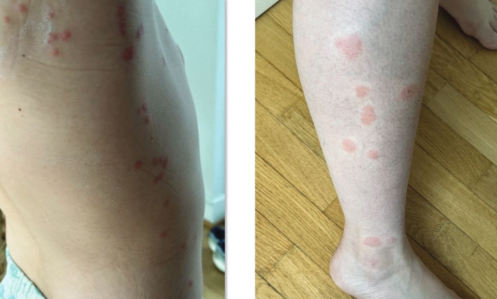 一家四口搭商務艙遭床蝨狂叮！空服員竟要他「安靜一點」…全家怒告求償628萬