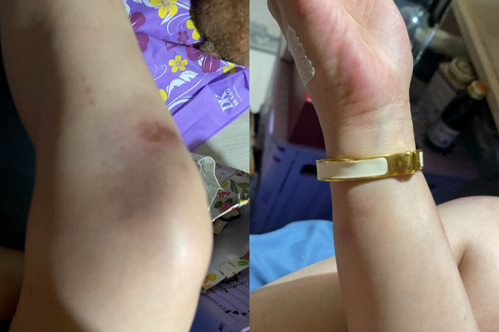 侯沁潔遭警方壓制逮捕全身瘀青,手上金飾也變型。翻攝侯沁潔臉書