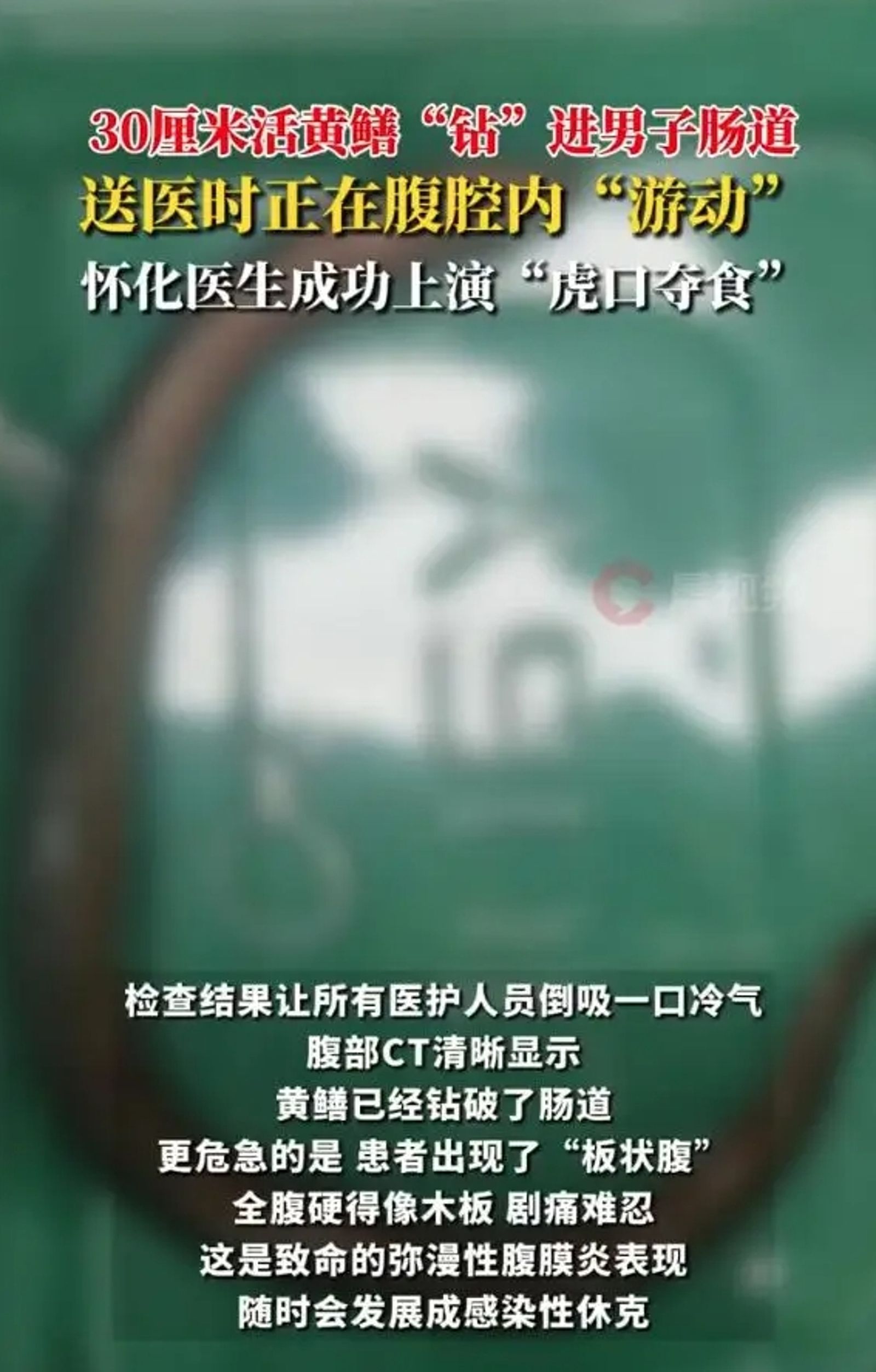 一條黃鱔透過肛門鑽進男子體內。圖／翻攝自微博