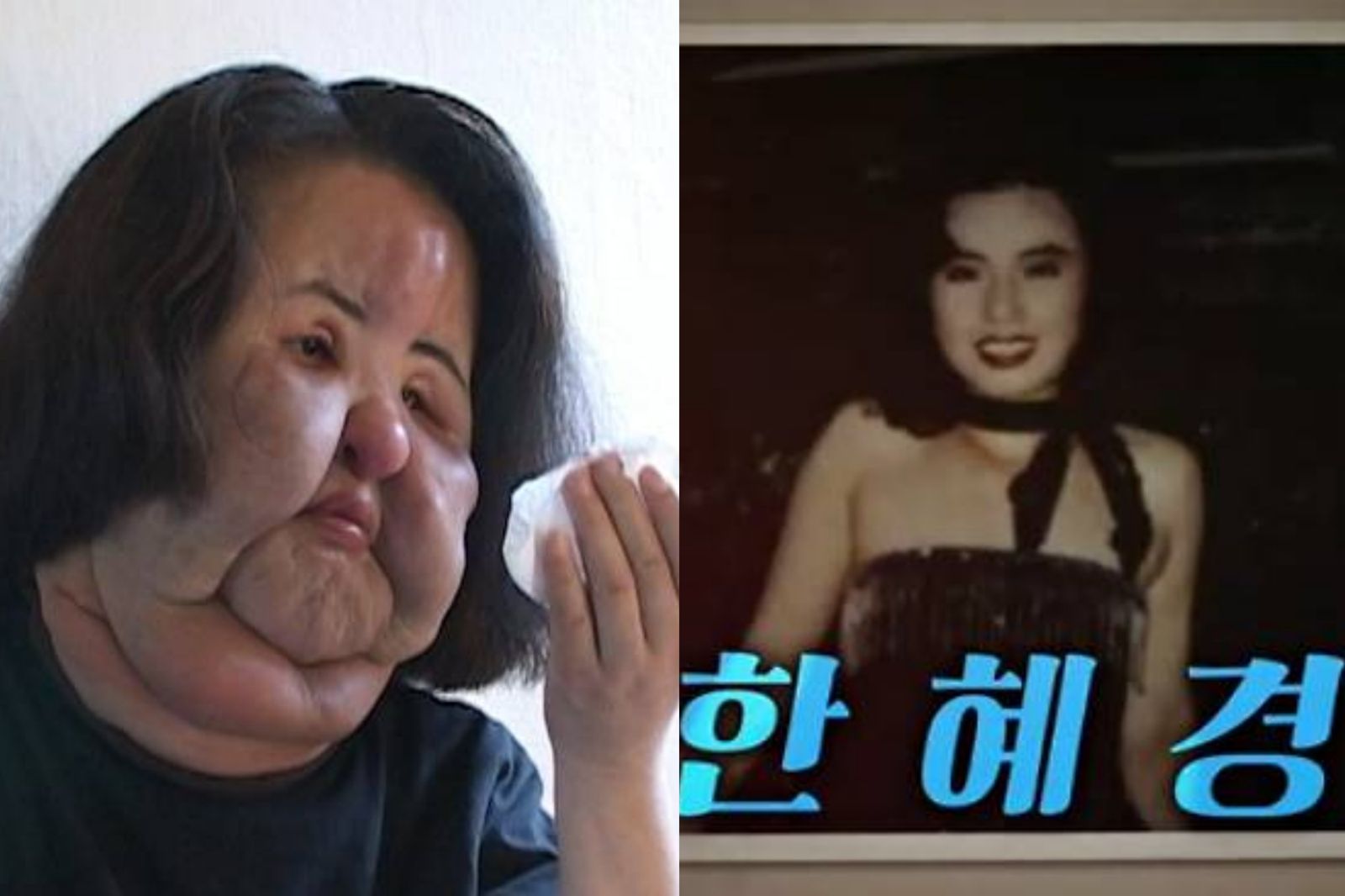 17次整形重建救不回！「電風扇阿姨」沙拉油注臉死因仍是謎　親姊首揭失控關鍵