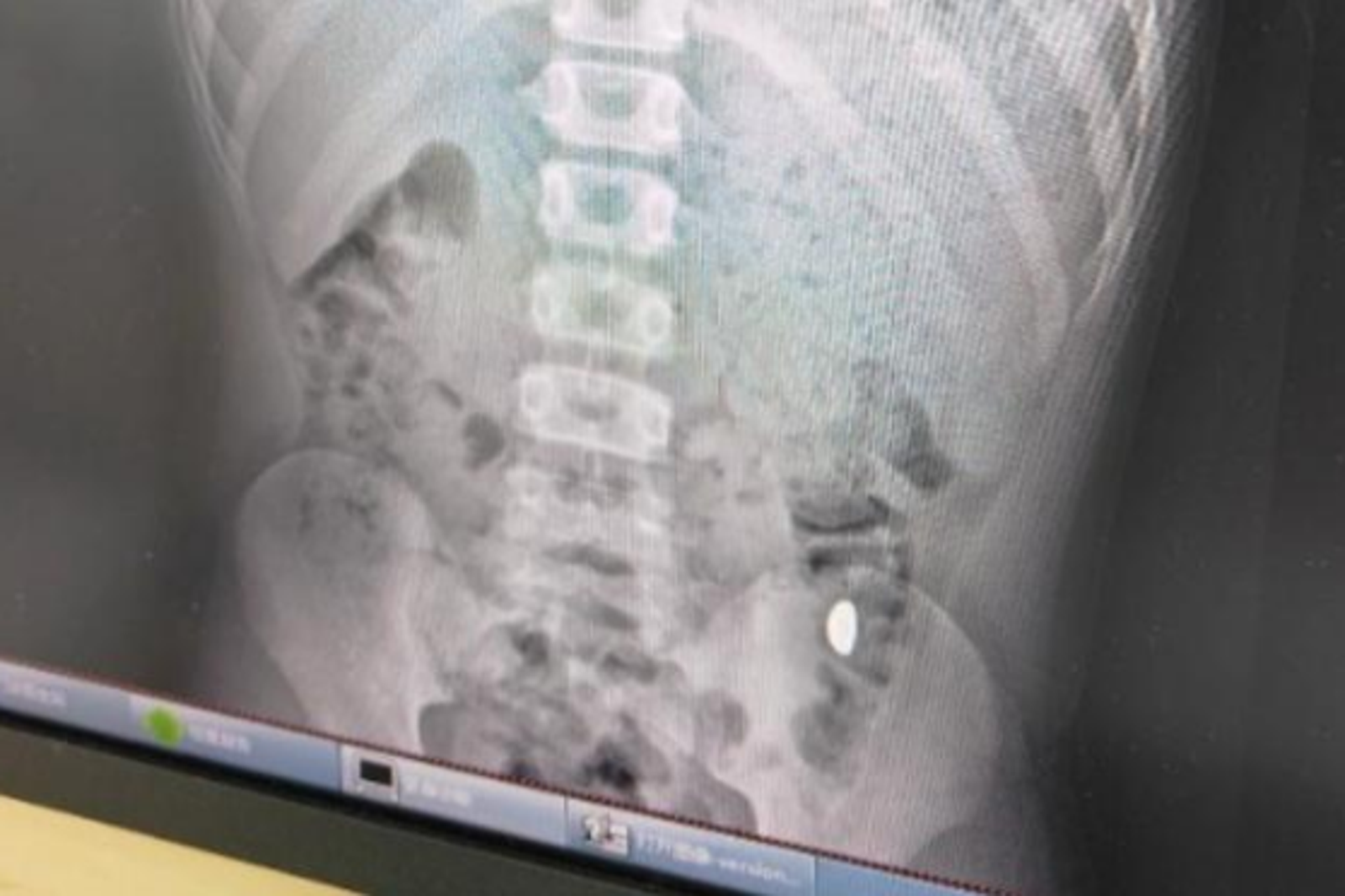 11歲男童將10克重黃金豆吞下肚。圖/翻攝自微博