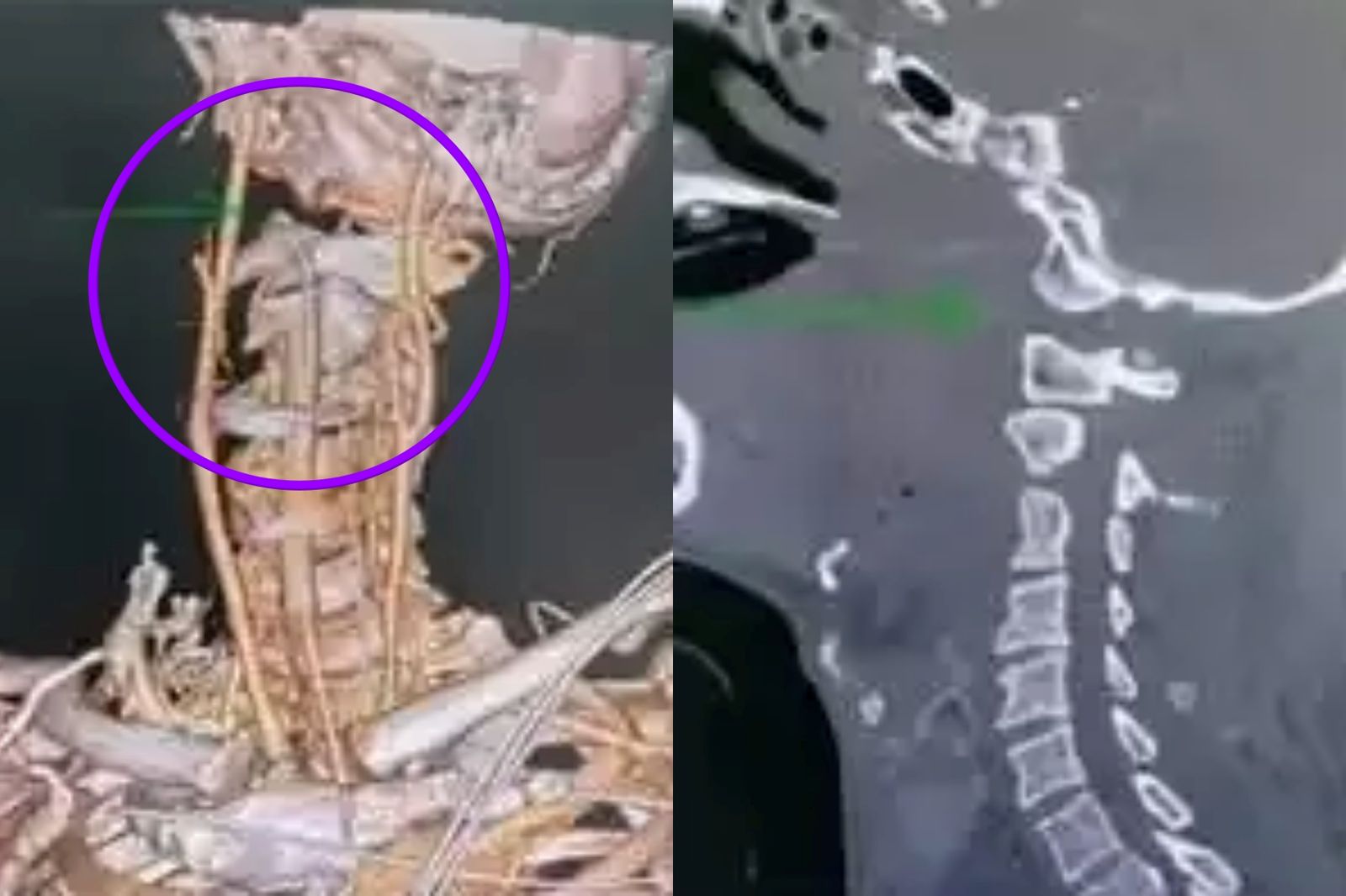 6旬男頭頸分離、顱內出血　醫見「活著到院」：已是奇蹟
