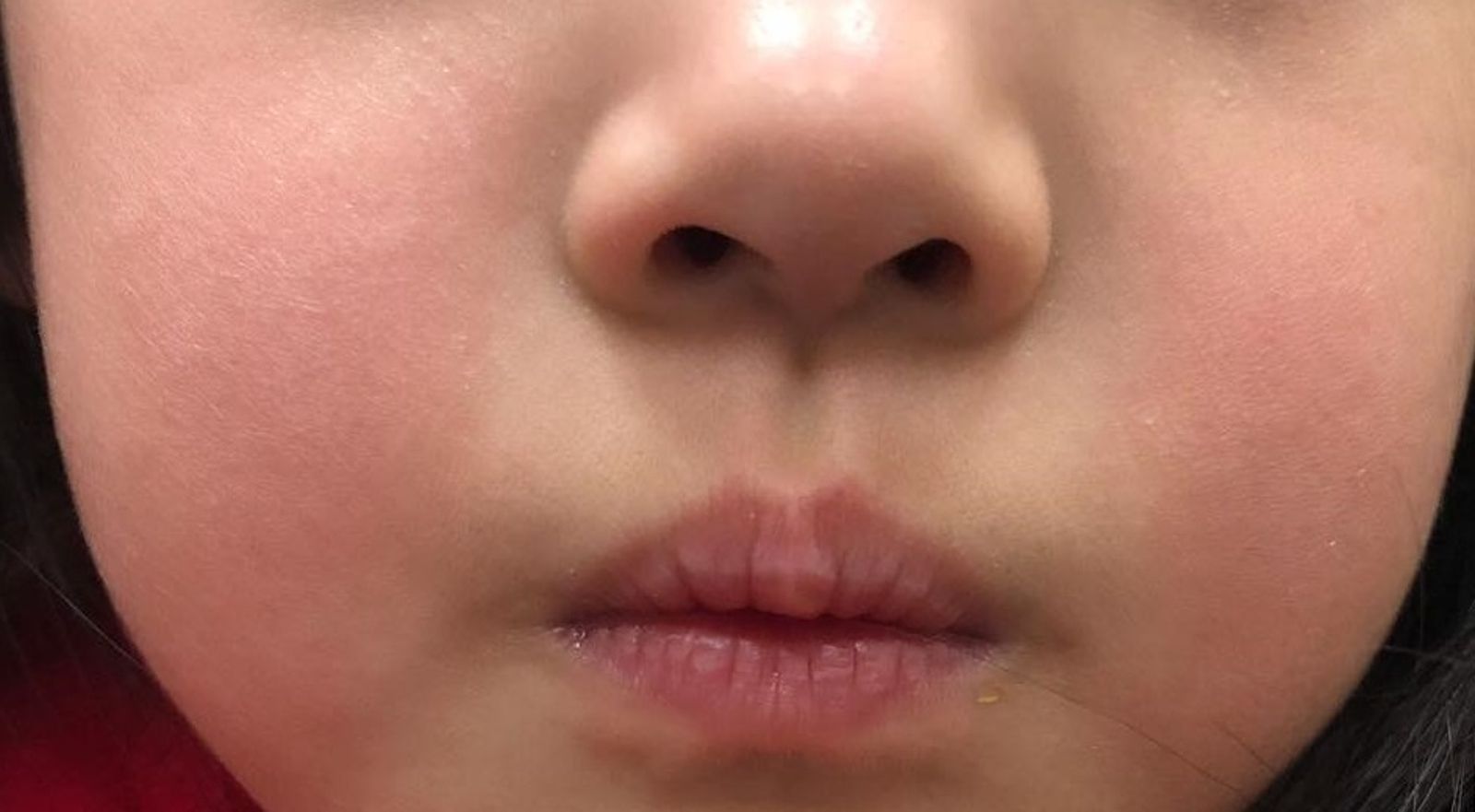 蘋果臉不是凍傷？恐是B19病毒作祟　3 大族群慎防嚴重併發症