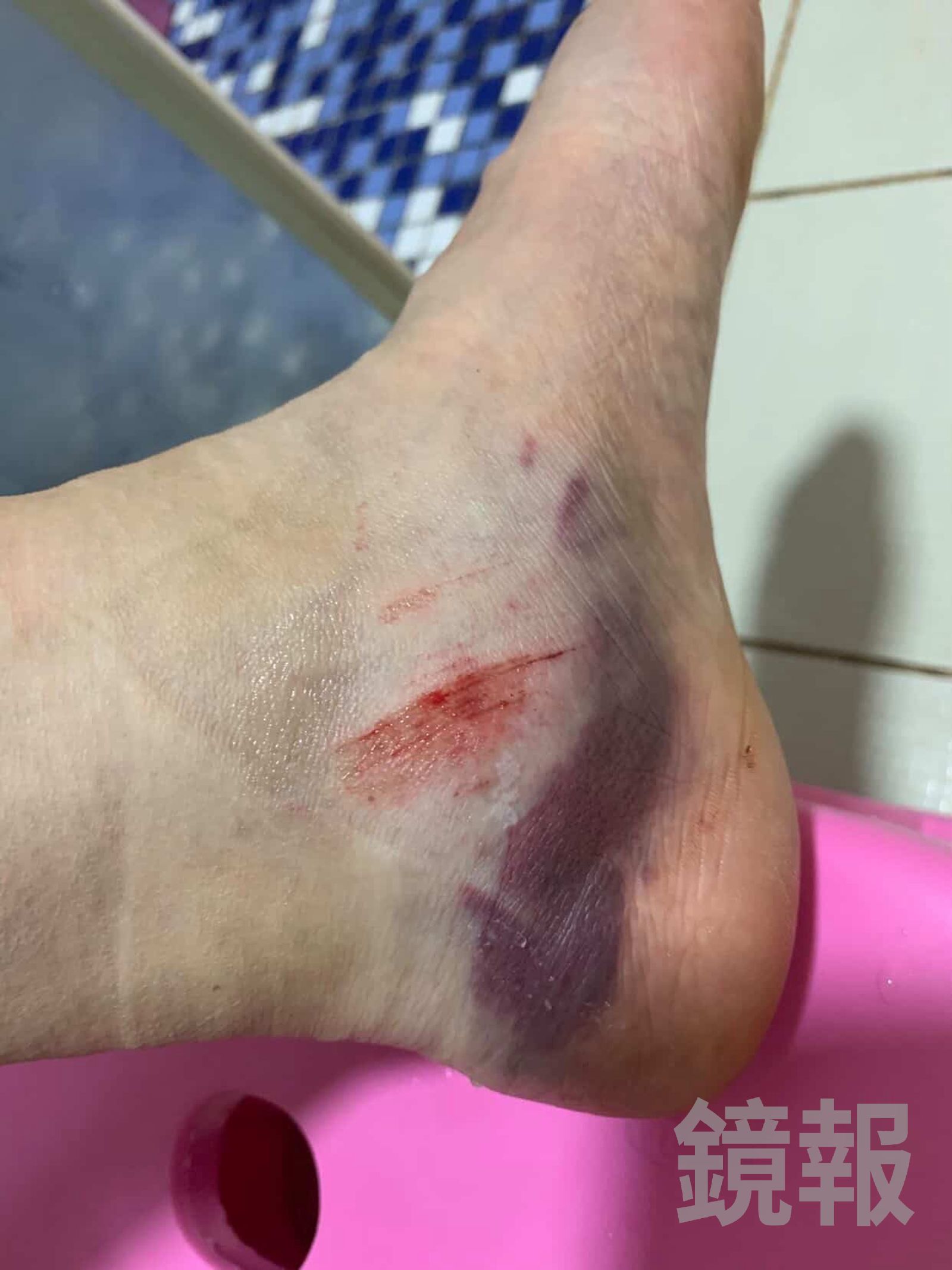 台中馬卡龍公園機車停車場的水泥磚害單親媽腳掌骨裂。