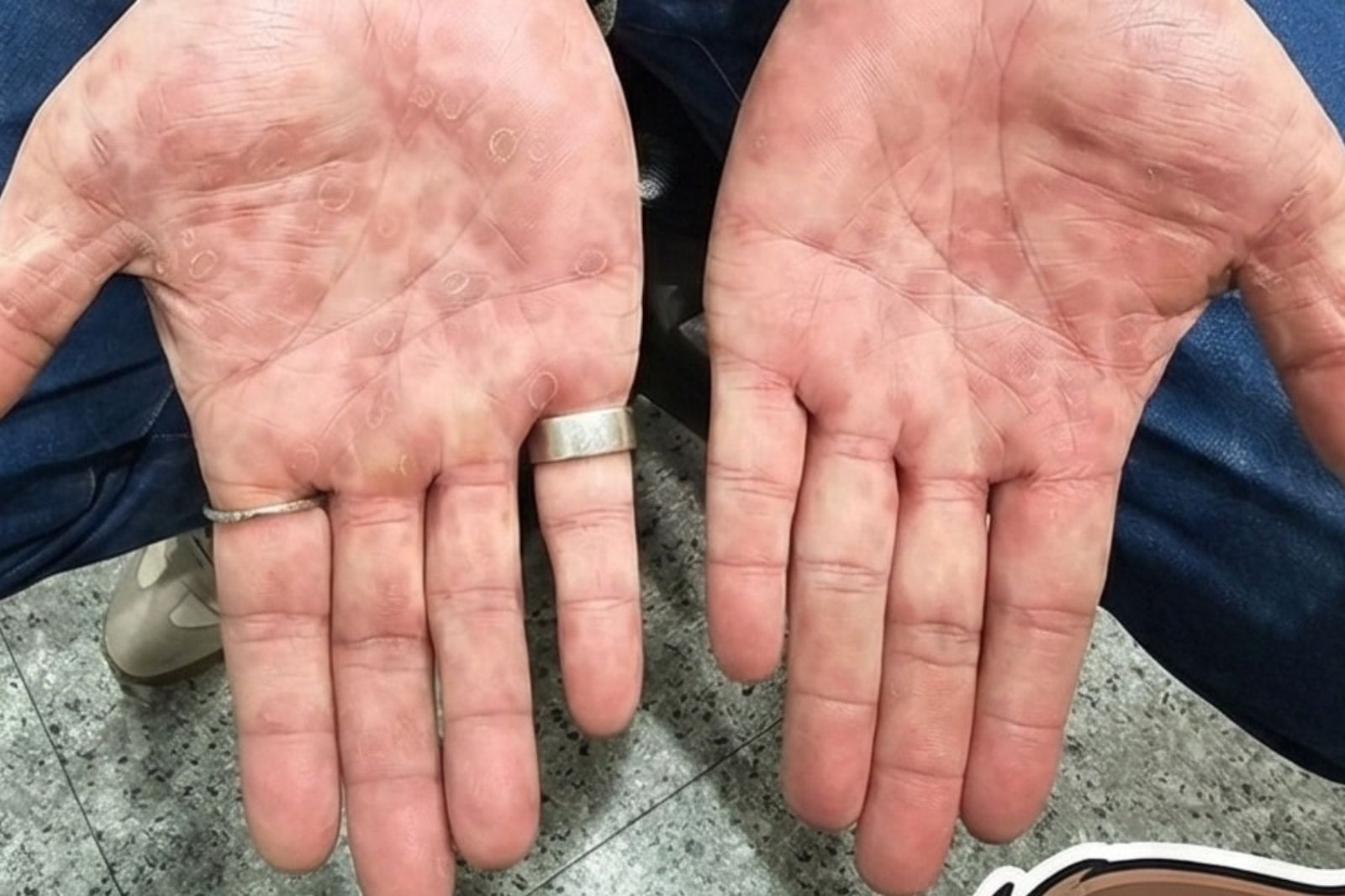 男子露營「以為被蟲咬」雙手長滿紅斑　問AI回答：你得梅毒了