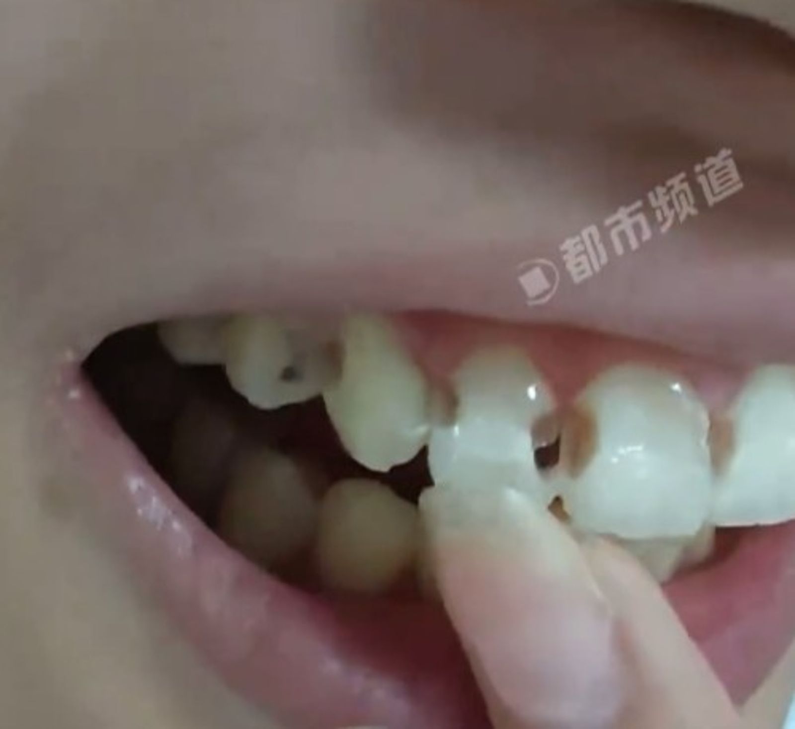 女子牙齒出現坑洞。圖/翻攝自微博