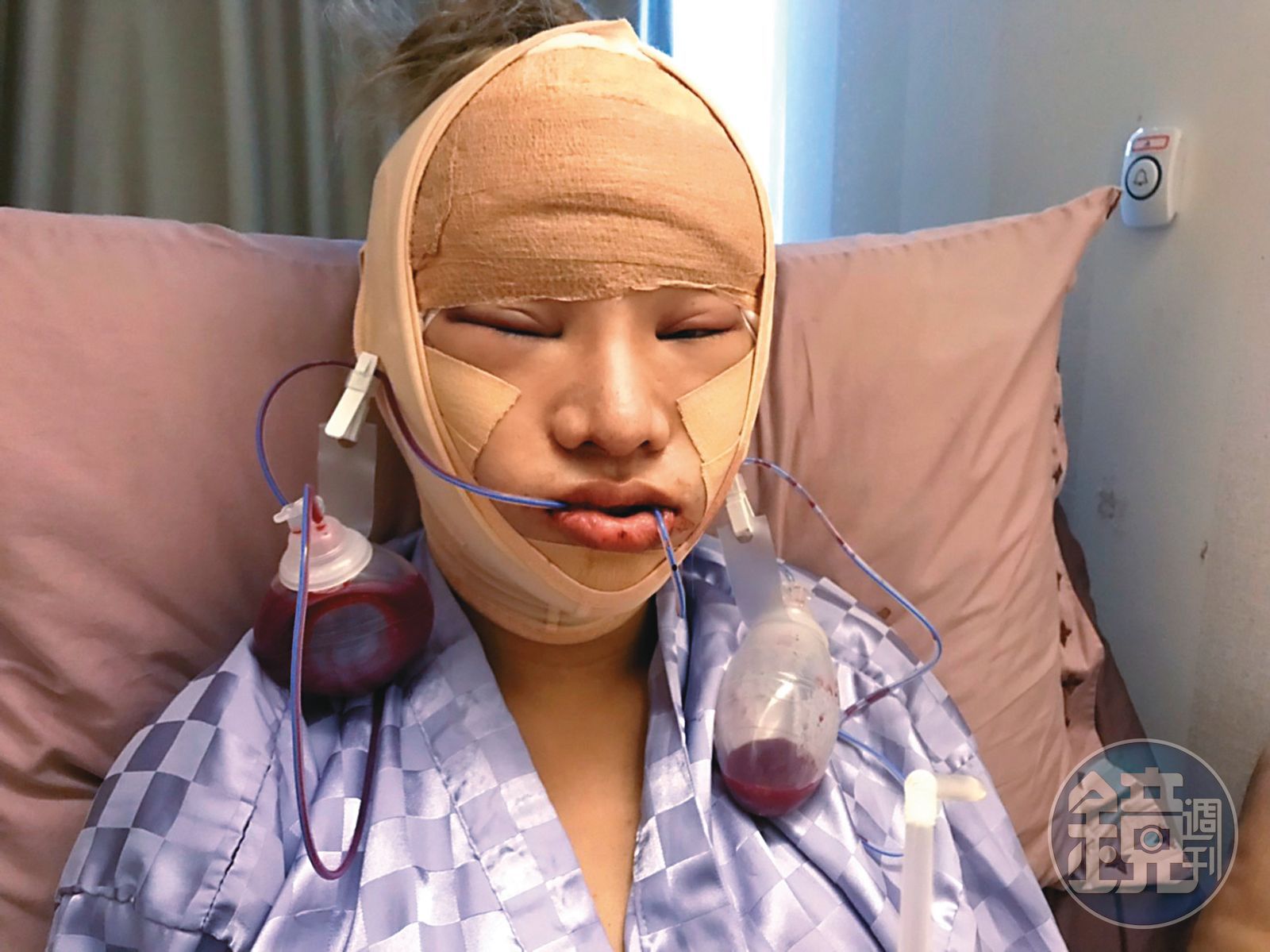 小A辣花在全身上下整形的費用已超過300萬元。鏡週刊