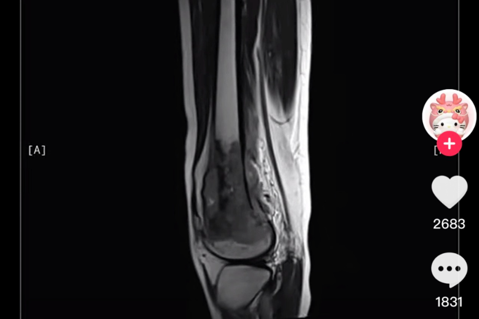 呆呆羊分享自己的診斷報告。圖/翻攝自TikTok@il1il1il1il1il