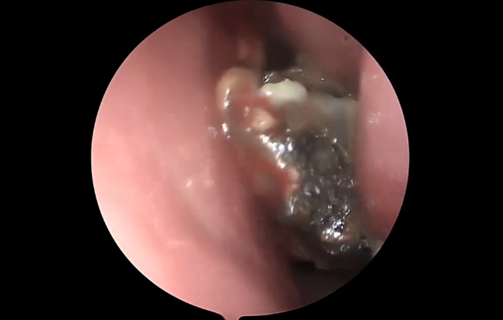 鼻子常聞到異臭感要當心　醫鼻腔深處挖出超大黴菌球畫面曝
