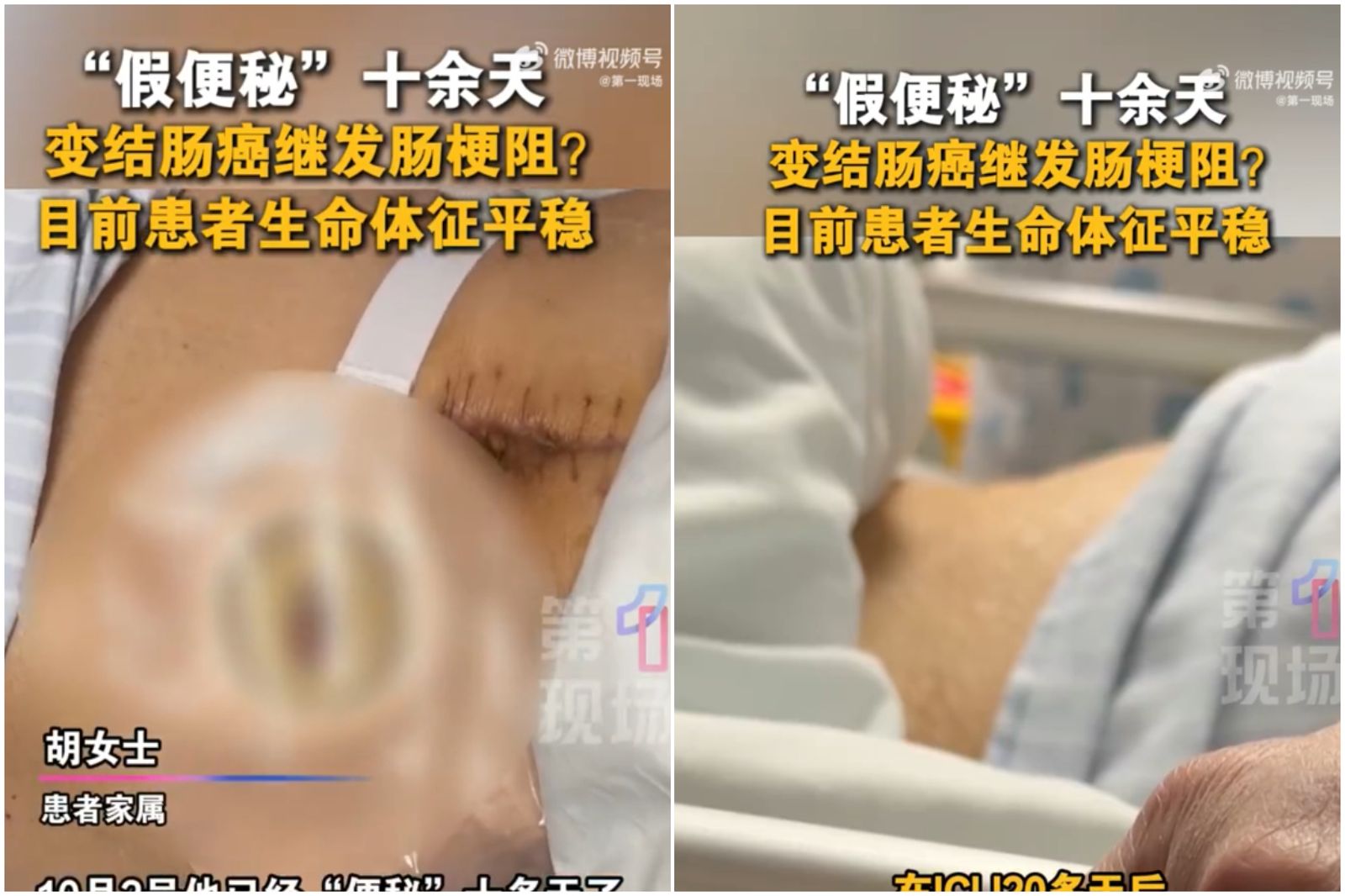 超噁！便秘男送醫插管「糞便從嘴巴噴出」　竟是得了「這種病」