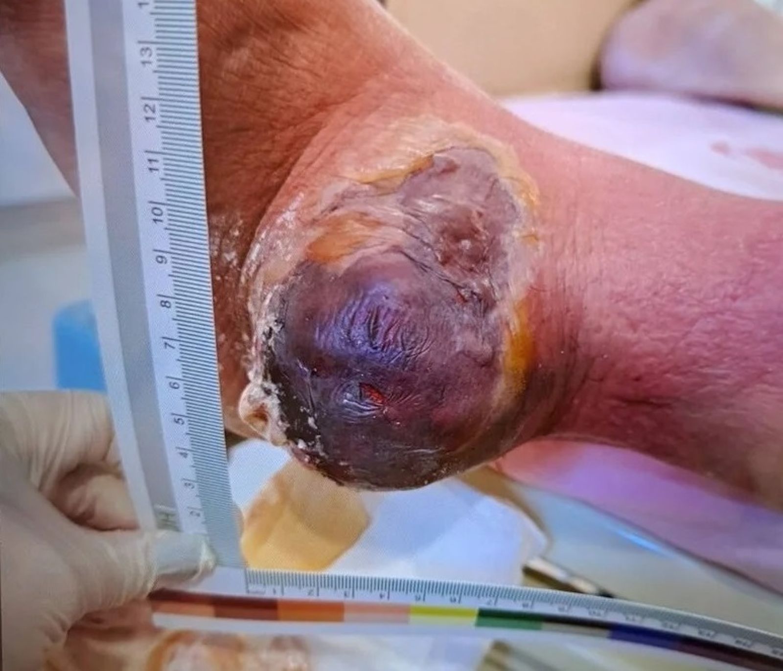 62歲男子罹患痛風卻不忌口，痛風石撐破皮膚「爆漿」。圖／亞大附醫