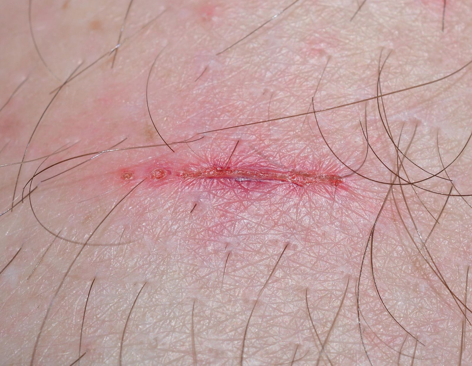 傷口結痂別碰?它才是留疤的元兇 醫曝正確處理方式