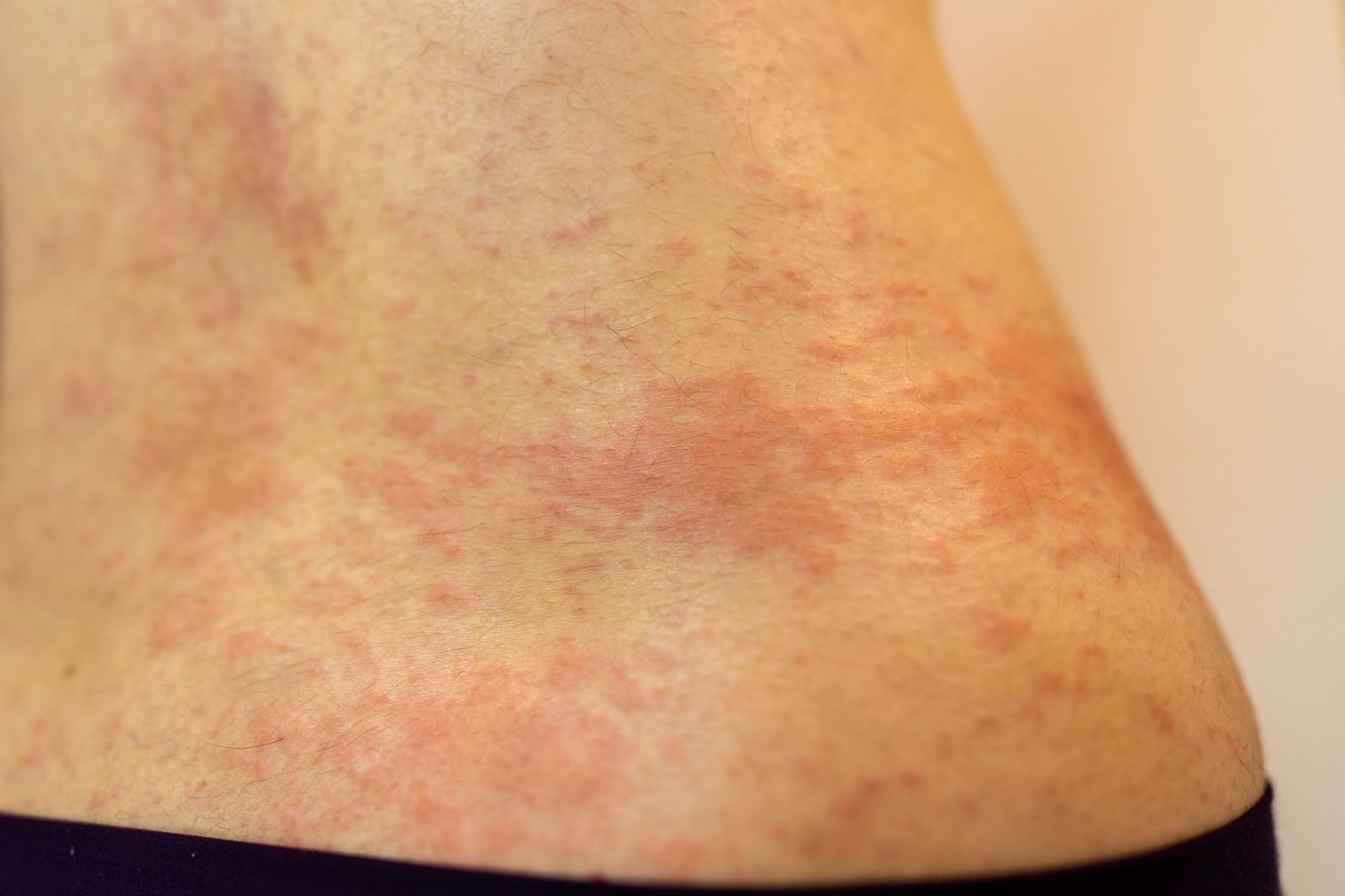 性行為後竟「全身長滿紅疹」！罕見真菌疫情爆發　醫示警：3類人風險最高