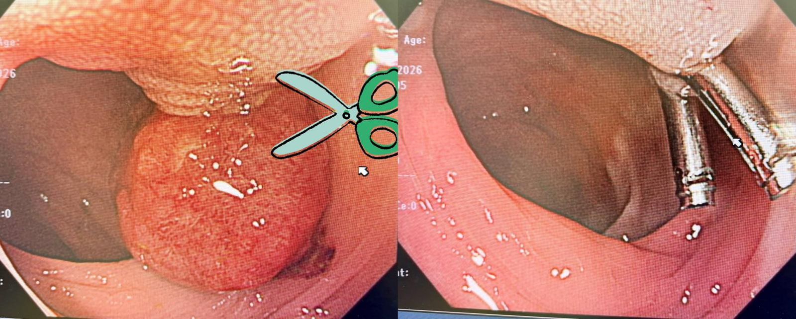 沒家族史也罹大腸癌！醫一天連切「3巨大腺瘤」驚呼：這3種肉不敢吃