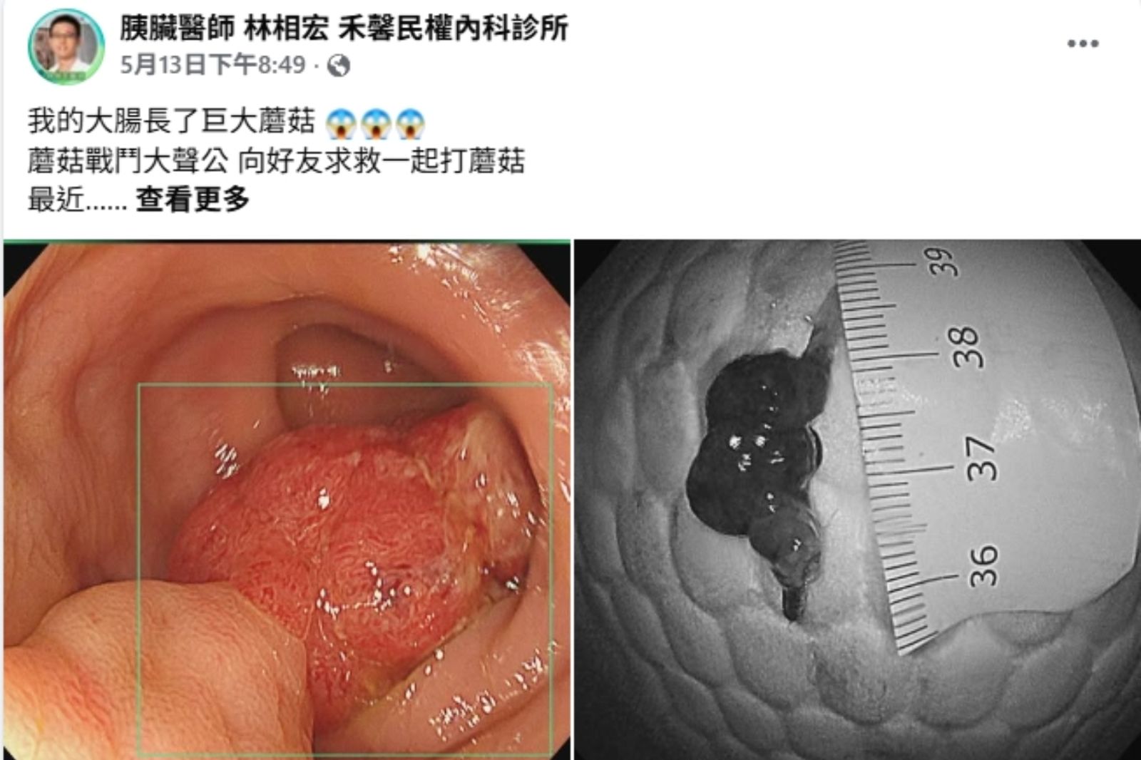 以為是痔瘡!他血便一整年 醫檢查驚見「巨大蘑菇」嘆:已經癌化了