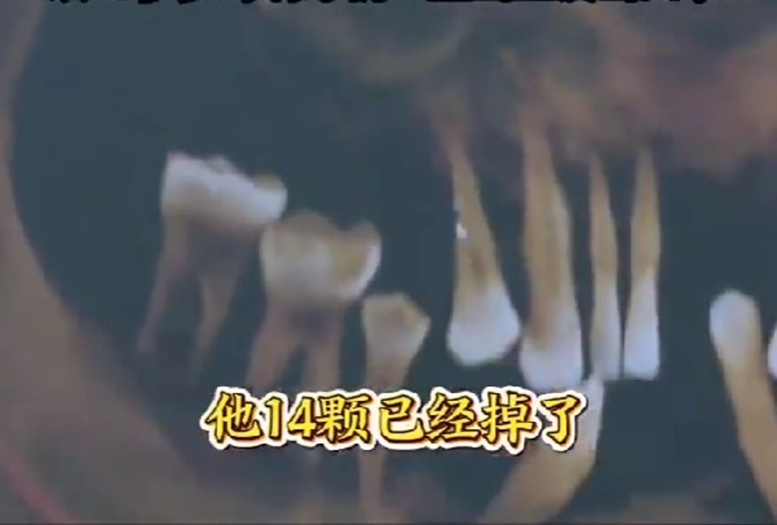 忽視牙齦出血20年!44歲男28顆牙全沒了 專家示警恐傷到心臟