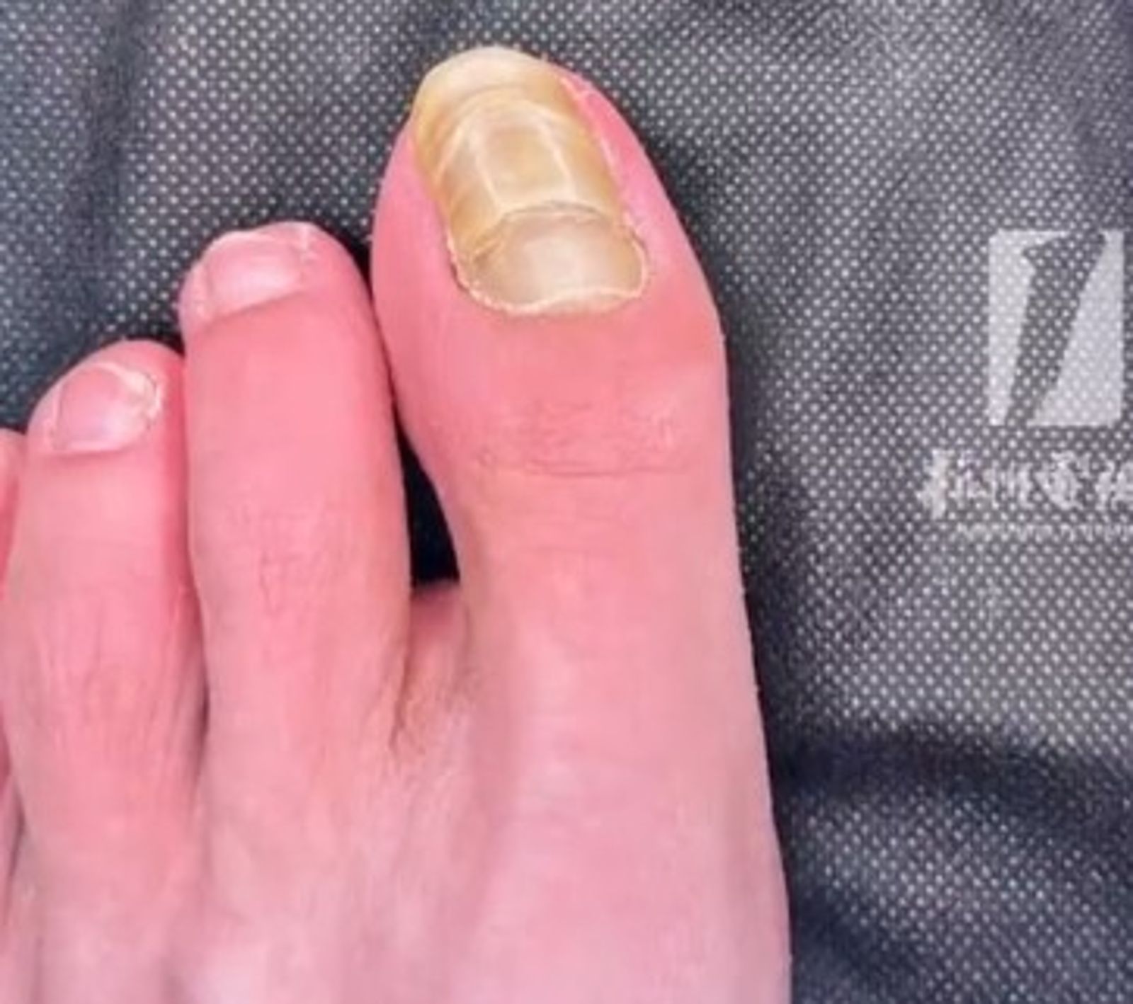 女子腳趾甲呈千層狀。圖／翻攝自微博／三農頻道