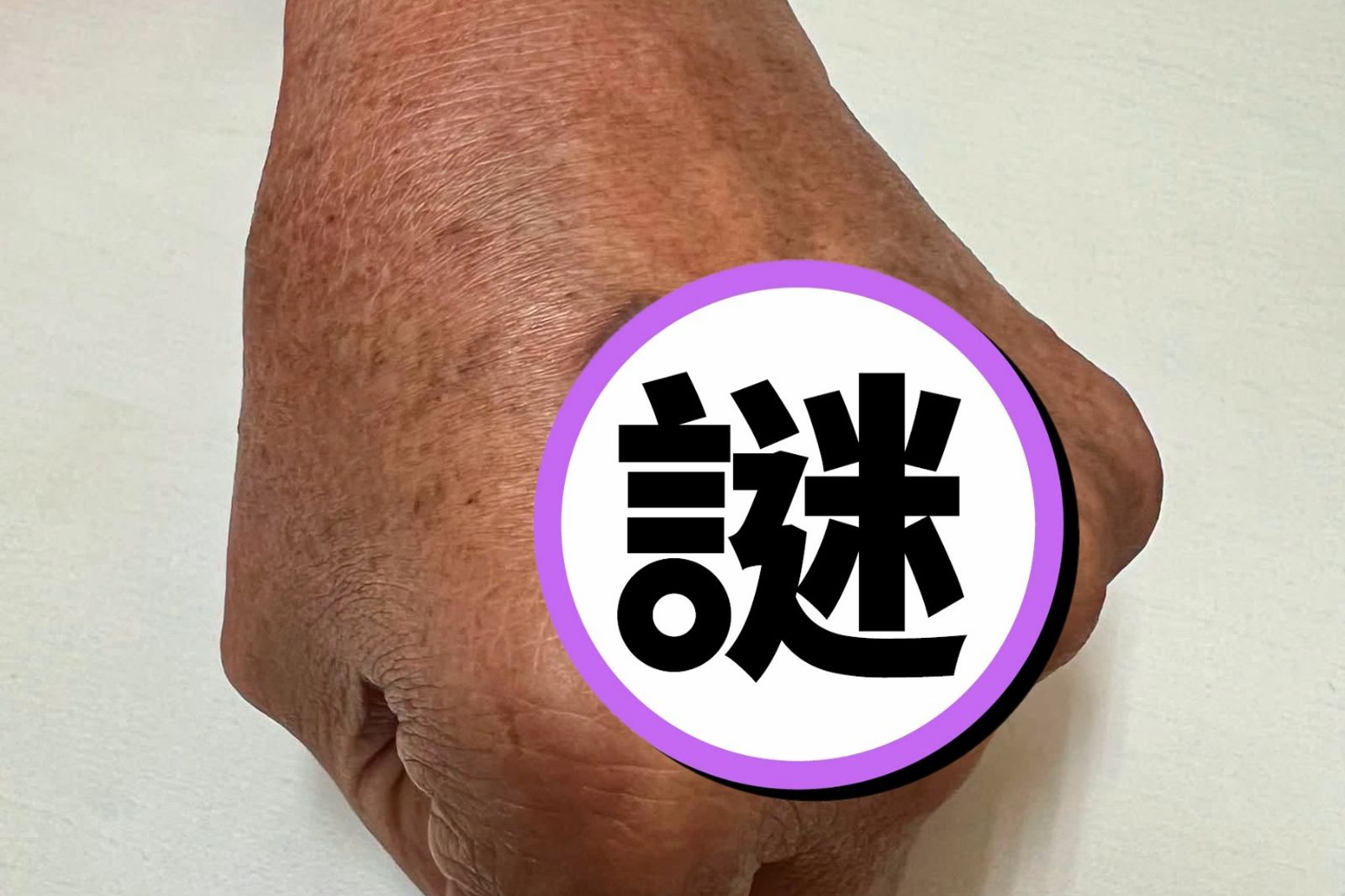 手背抓3年長出「咖啡色盔甲」!醫師曝形成原因:不是濕疹、黴菌引起