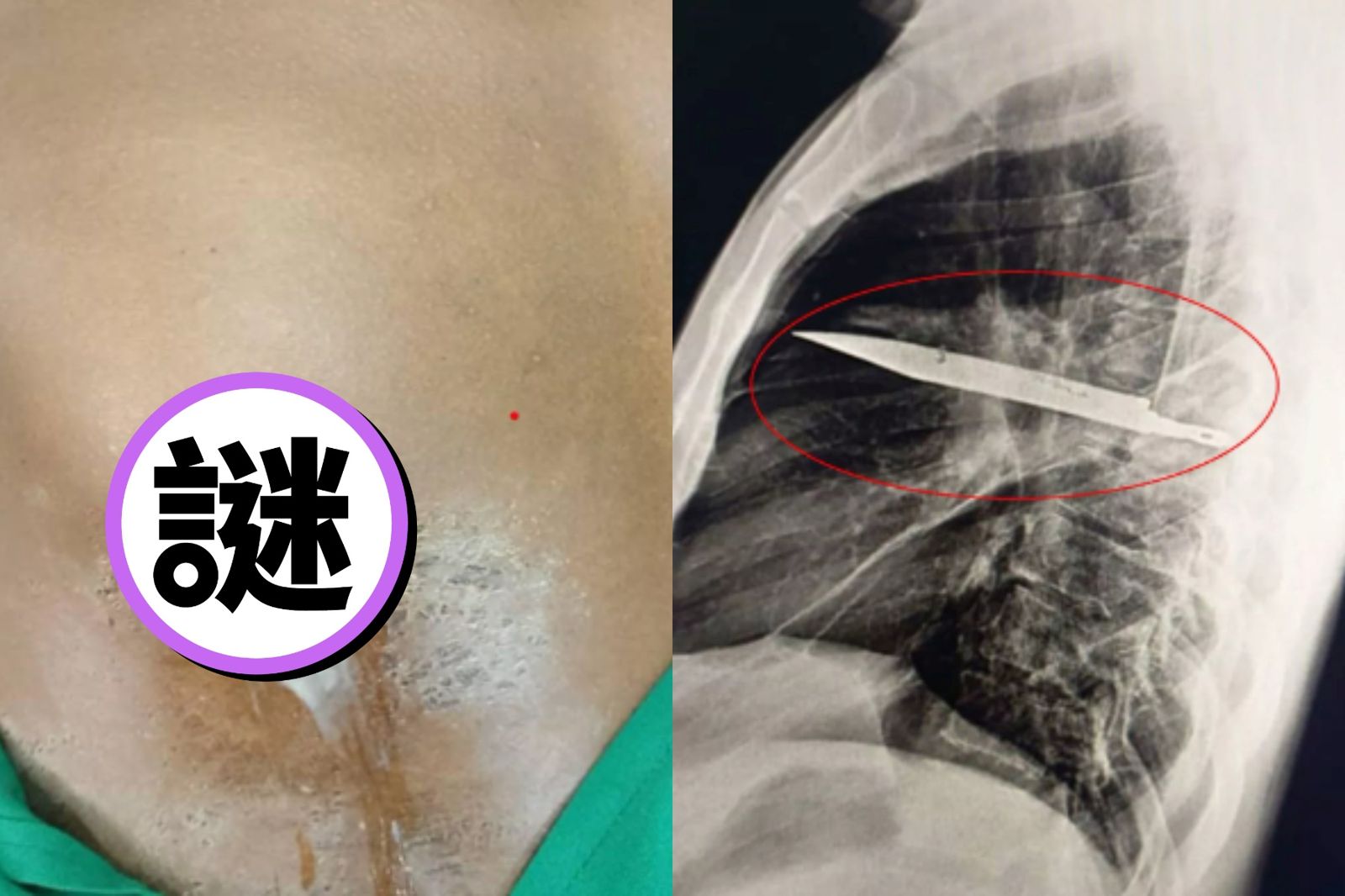 扯！44歲男胸部流膿　照X光檢查才發現「刀片插胸腔8年」完美避開所有器官
