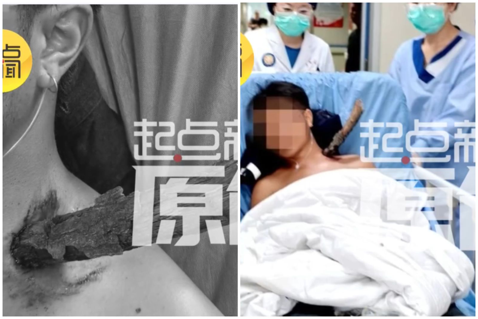 超粗樹枝「插入頸部」戳進胸腔12公分！　男子下場曝光