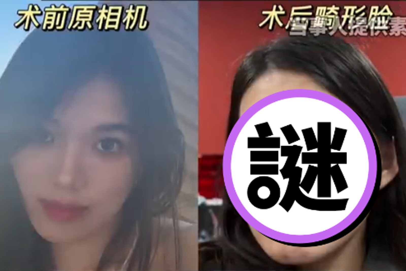 正顎手術變「朱元璋」!醫師稱「面相更洋氣」她氣炸用AI編曲告誡眾人