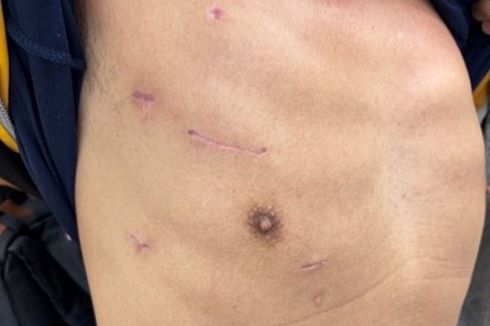 心臟手術不再可怕!不用鋸胸骨改微創+精準麻醉 71歲患者4天就出院