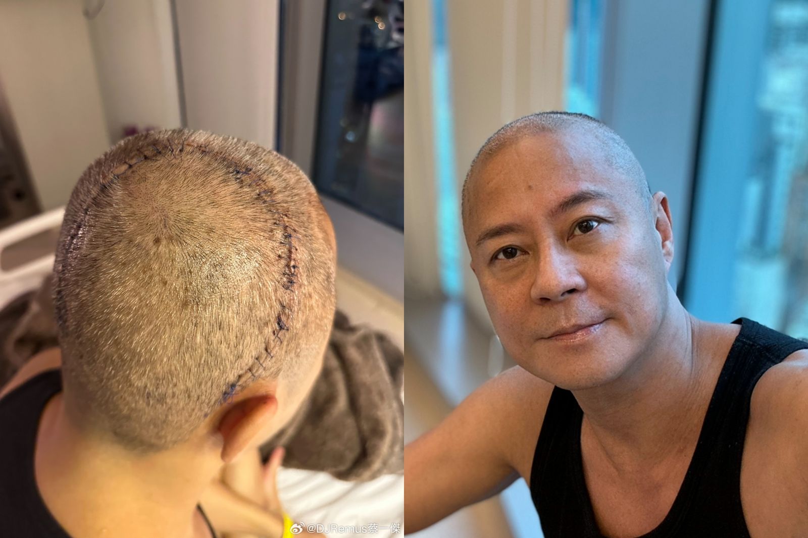割7公分巨大腦瘤又爆擴散!「草蜢」成員蔡一傑傳癌症復發 親回:吃得好、睡得飽我非常健康