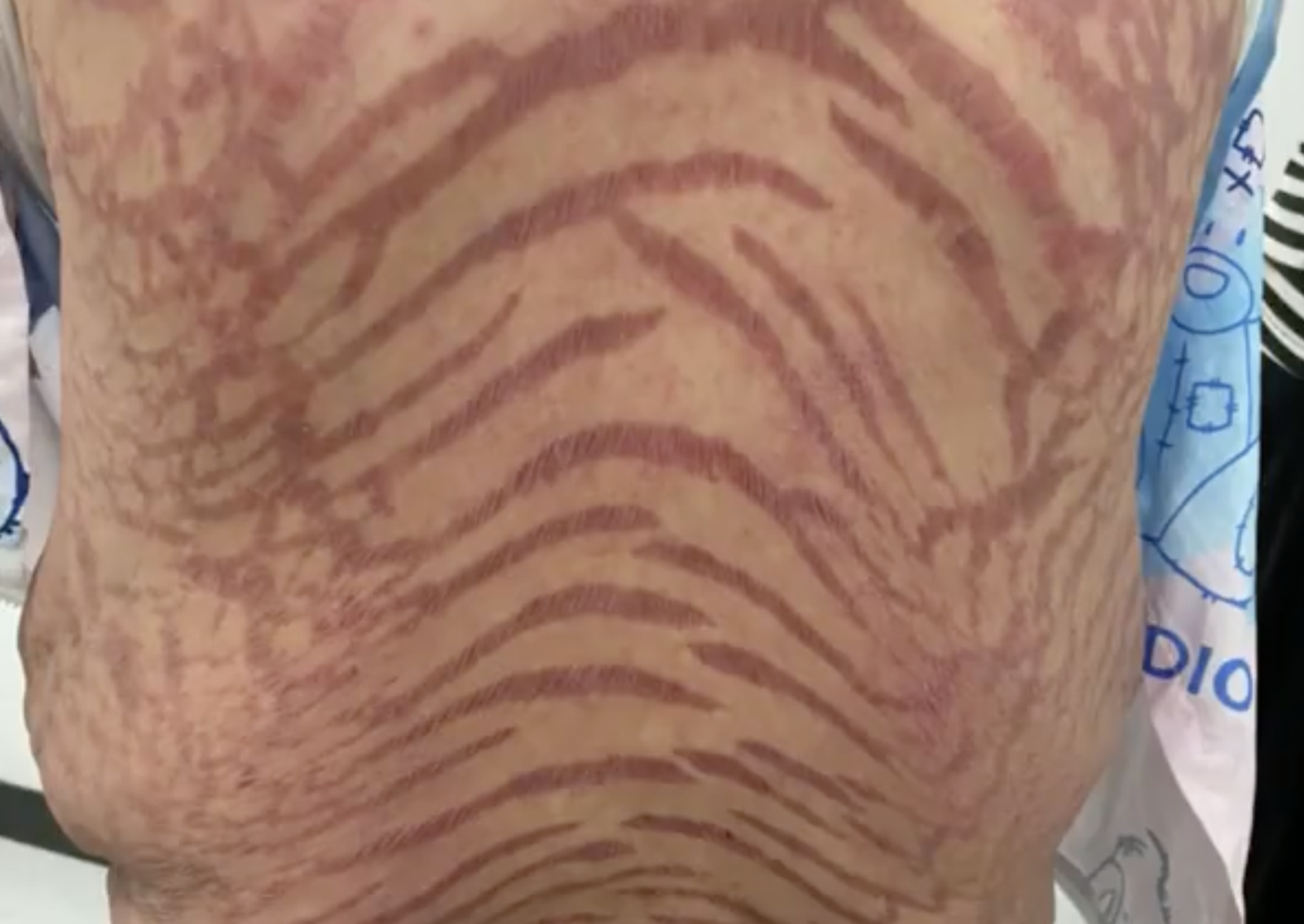 號稱治百病！40歲女狂擦「網紅神藥」全身布滿蛇紋　醫師揭驚人成分