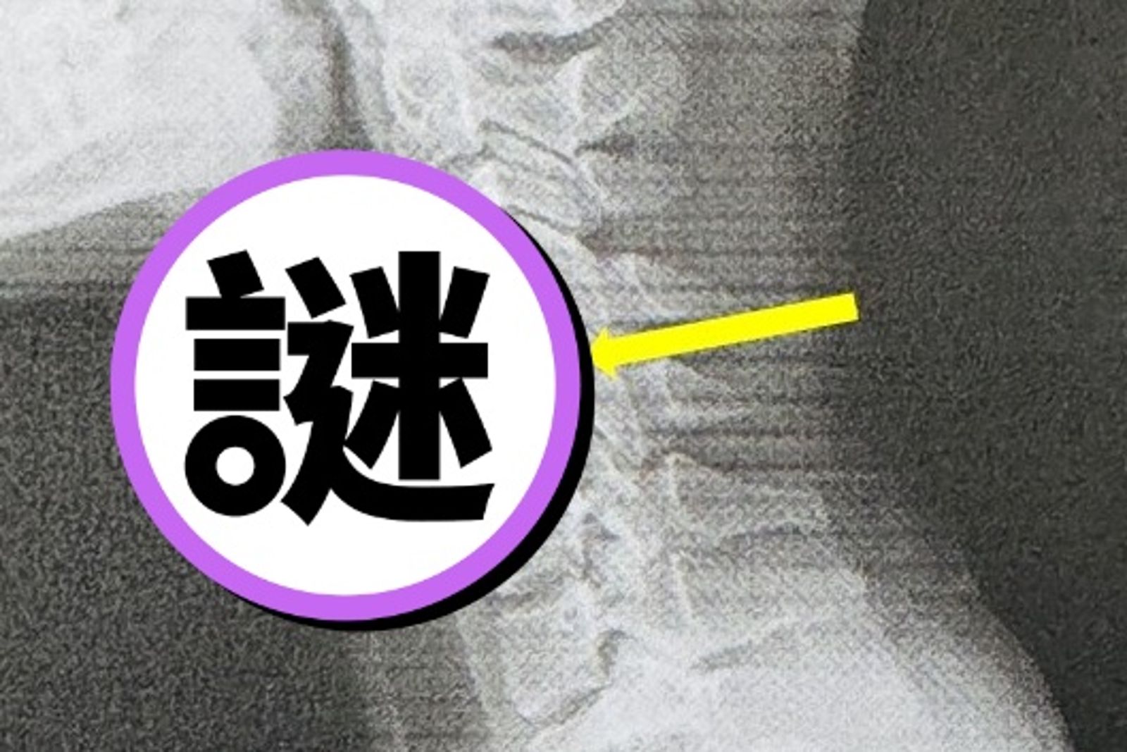 20歲少女60歲頸椎！完美C字硬成直線　醫示警：全身崩壞的開始　
