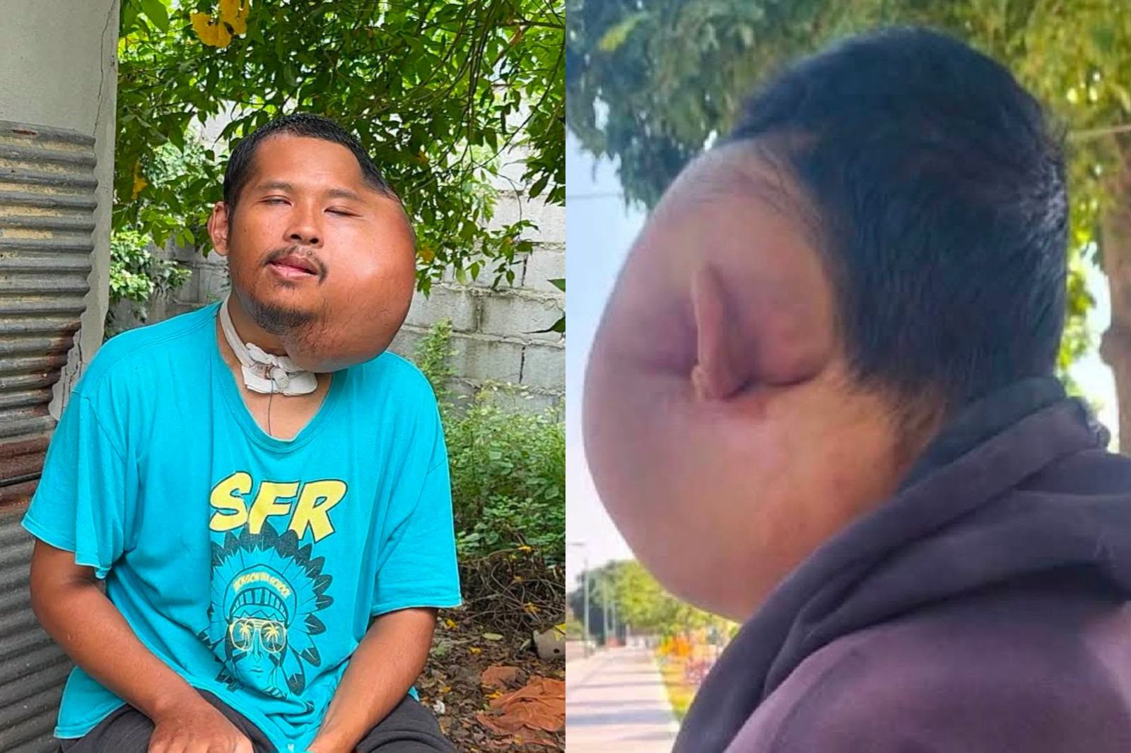 拿牙籤清蛀牙!他半邊臉腫到變形 竟慘長成惡性腫瘤