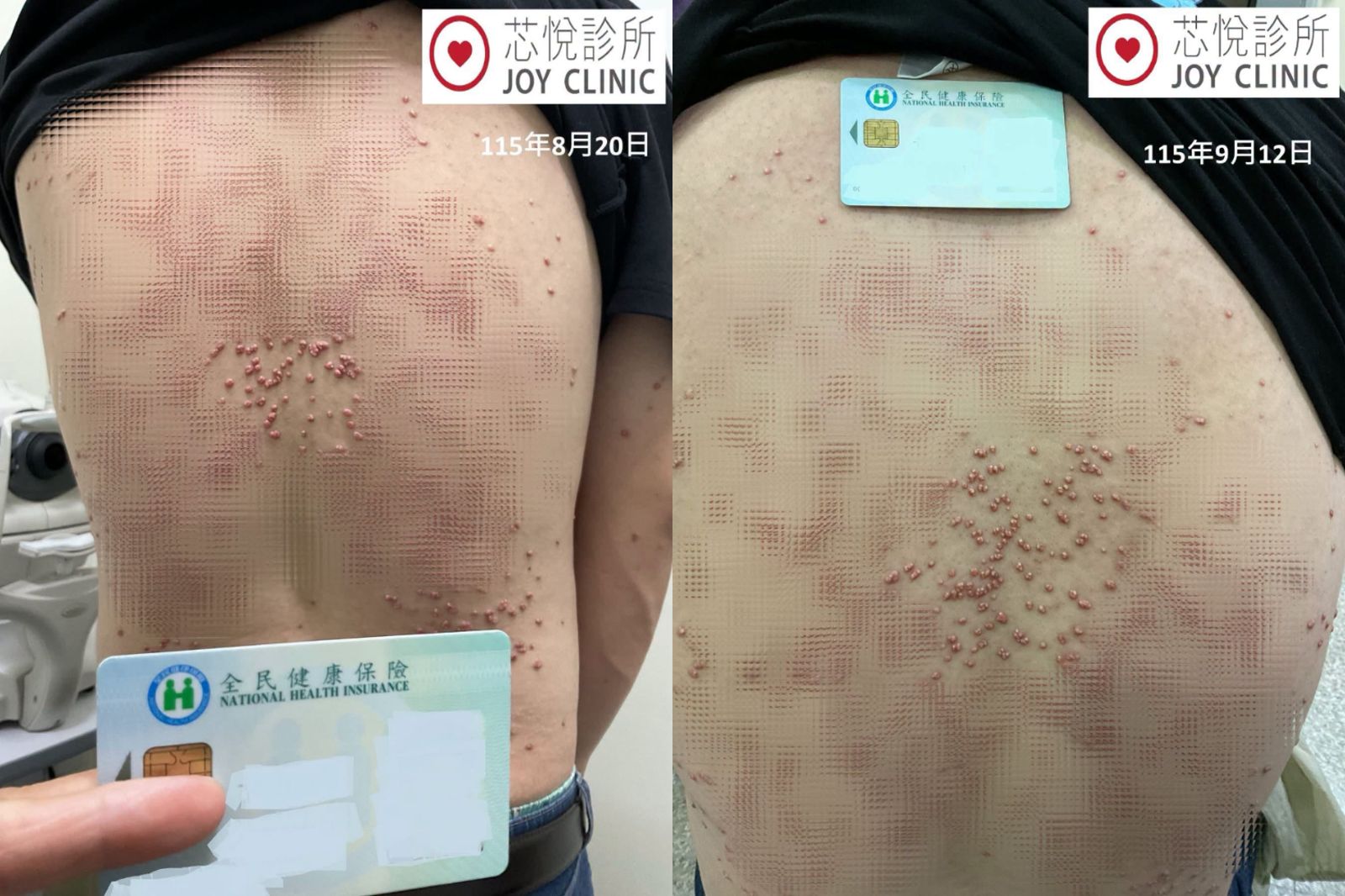 23歲男全身長滿「恐怖肉瘤」 醫師抽血大驚:飆破6000了!