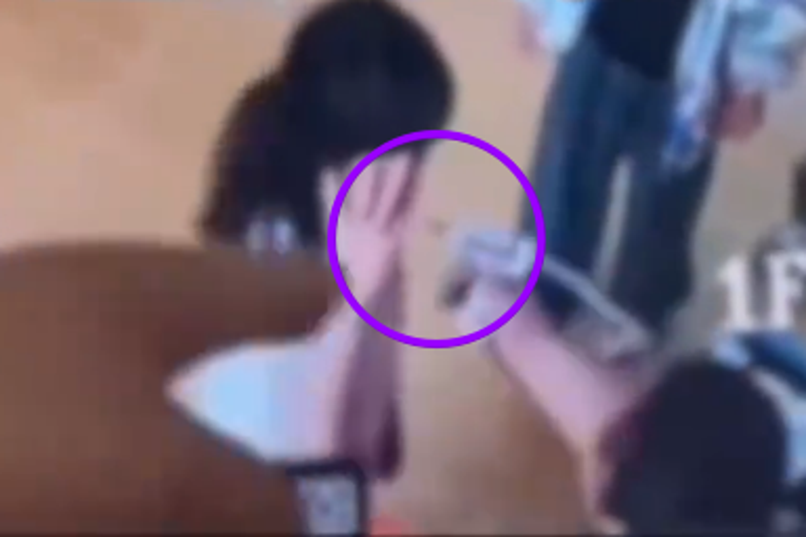 女童遭教師以熱熔膠燙嘴唇,導致嚴重水泡,潰爛流膿。圖/翻攝畫面