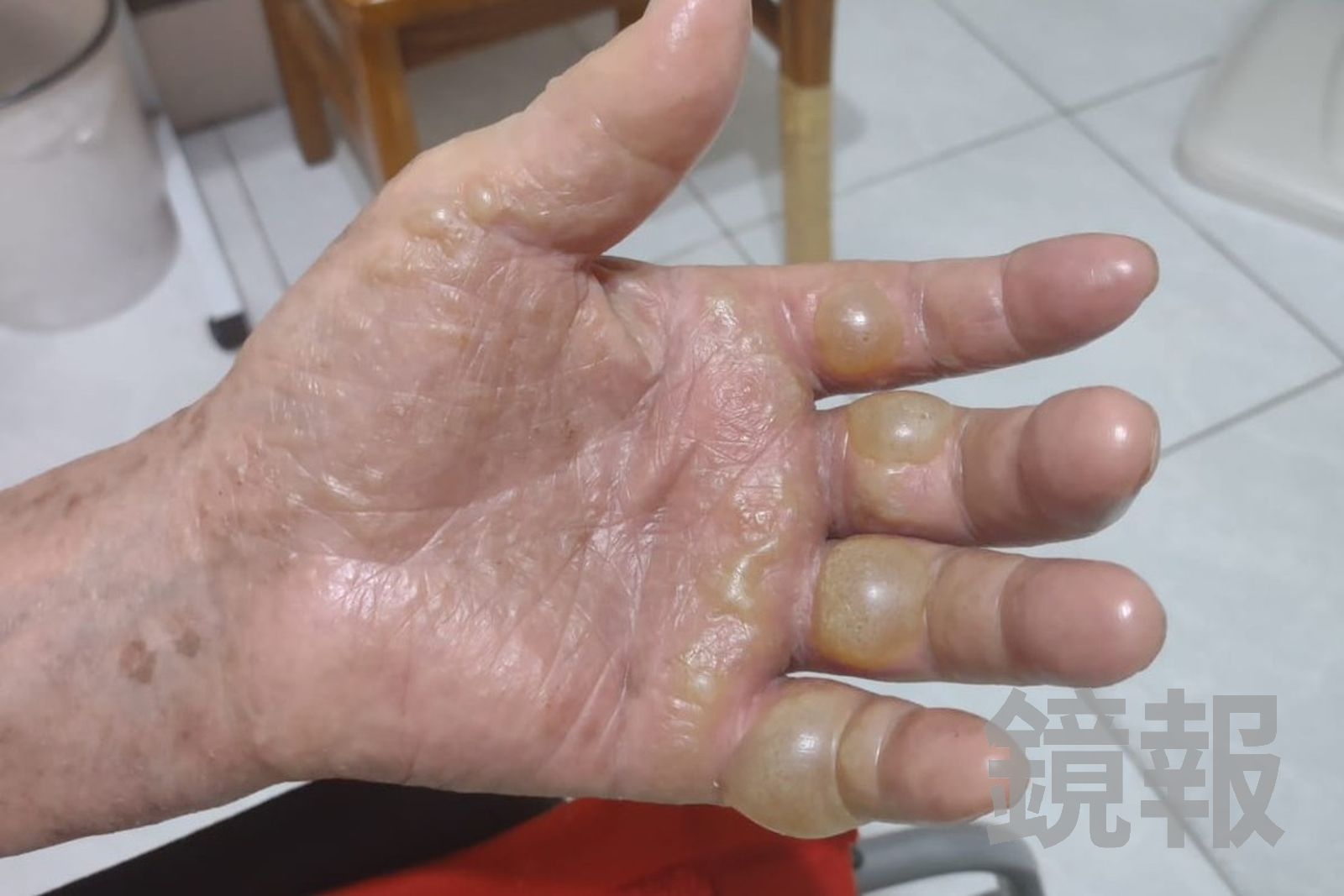 皮膚突然不斷冒出銅板大水泡？小心罕見自體免疫病「類天皰瘡」