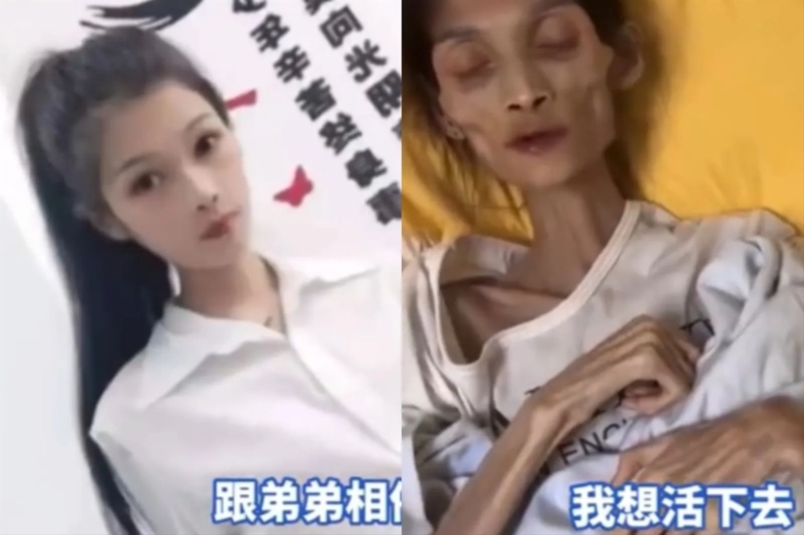 27歲美女「胃萎縮」瘦成骷髏剩17公斤　不幸過世