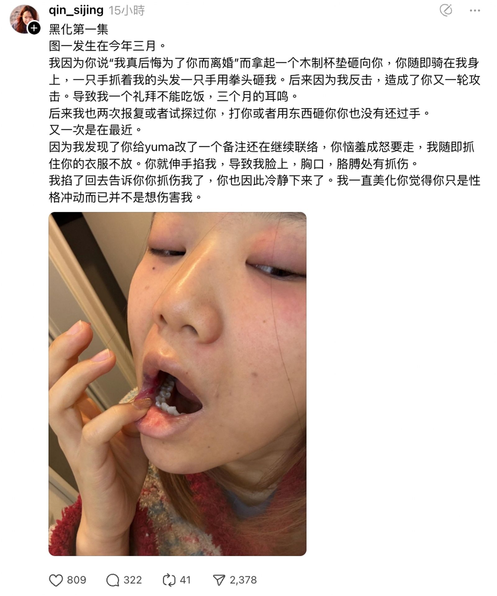 秦思靜曬出自己被打傷的照片。threads＠@qin_sijing