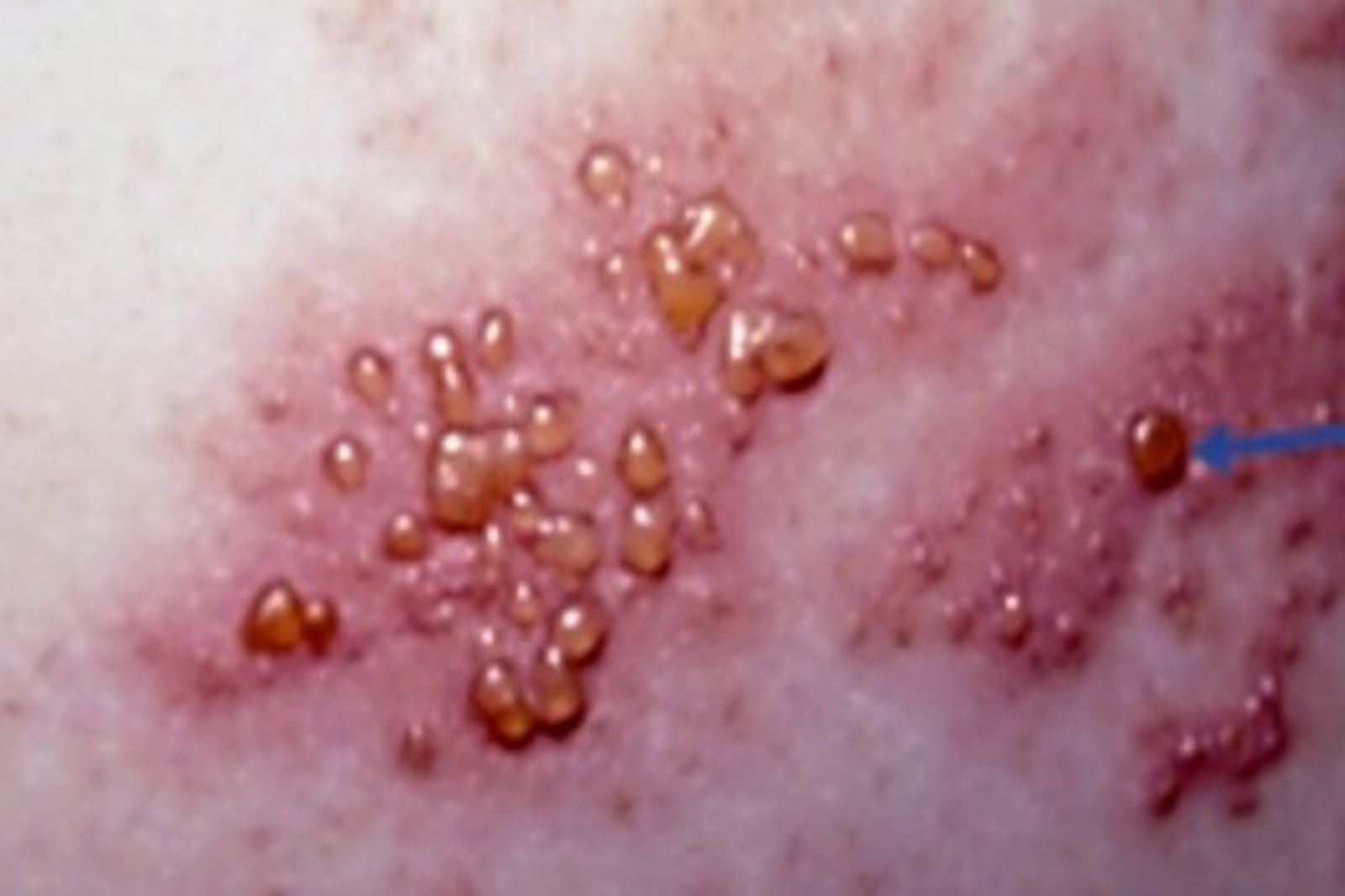 皮蛇上身比生小孩還痛!醫師教你5招「防蛇」