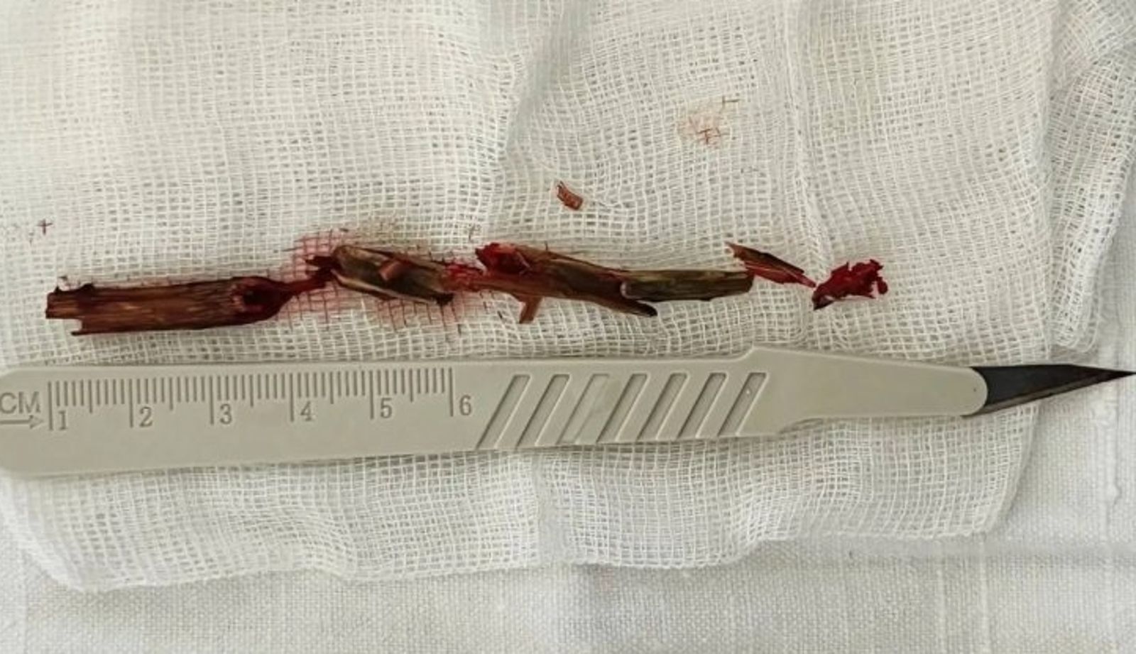 眼睛痛1年都治不好!男子照CT驚見「木棍直插腦部」...醫從鼻腔拉出「12公分木棍」