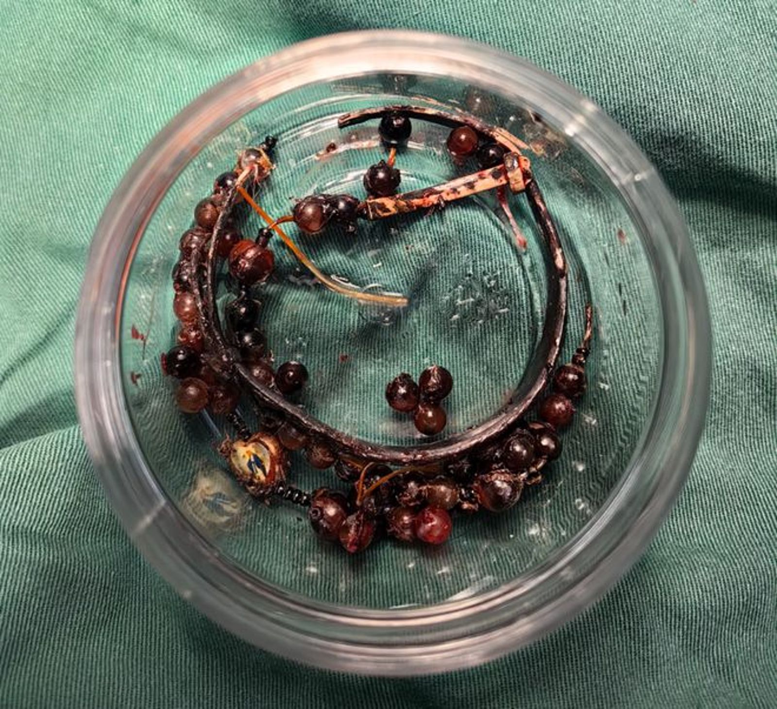 醫療團隊經過手術，成功將串珠和手鐲取下。圖／翻攝自微博