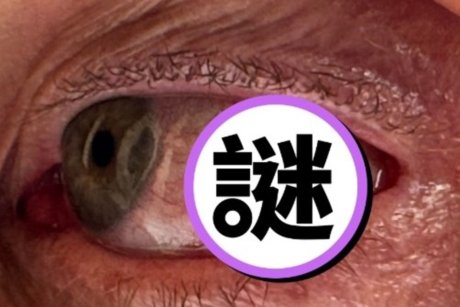 58歲男1動作...遭水蛭「狂吸眼球6小時」　他曝治療過程：像整個被撕開