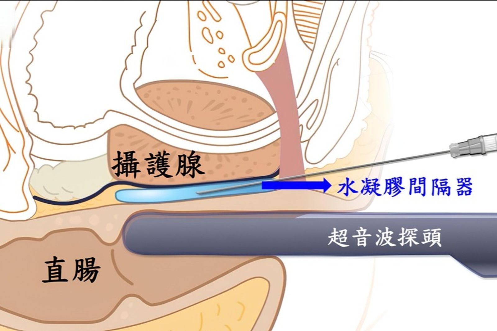 攝護腺癌治療大突破！水凝膠植入術護腸道、不再怕腹瀉出血