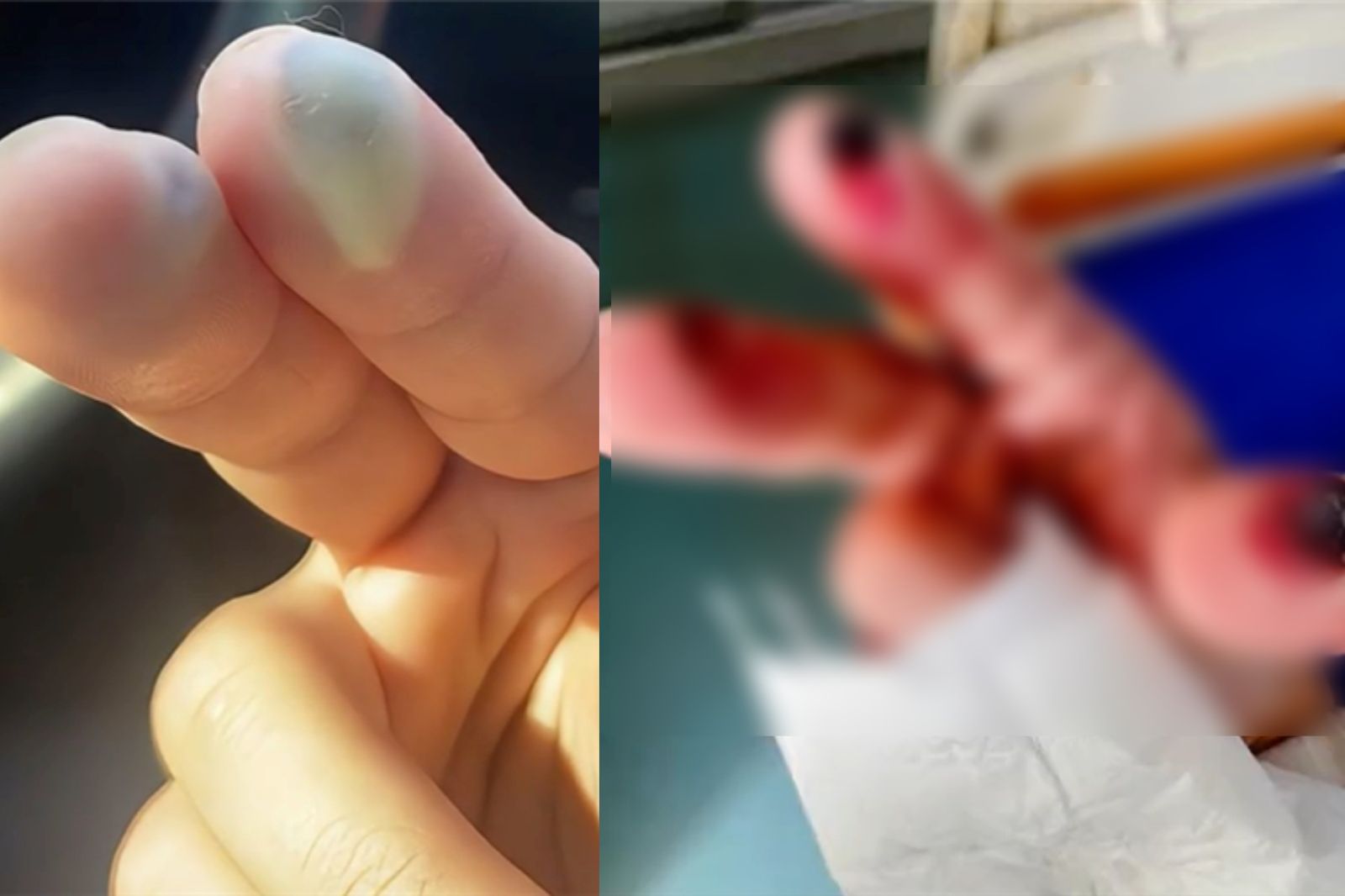 她誤踩「化骨水容器」遭2家醫院拒收！裝葉克膜仍宣告不治
