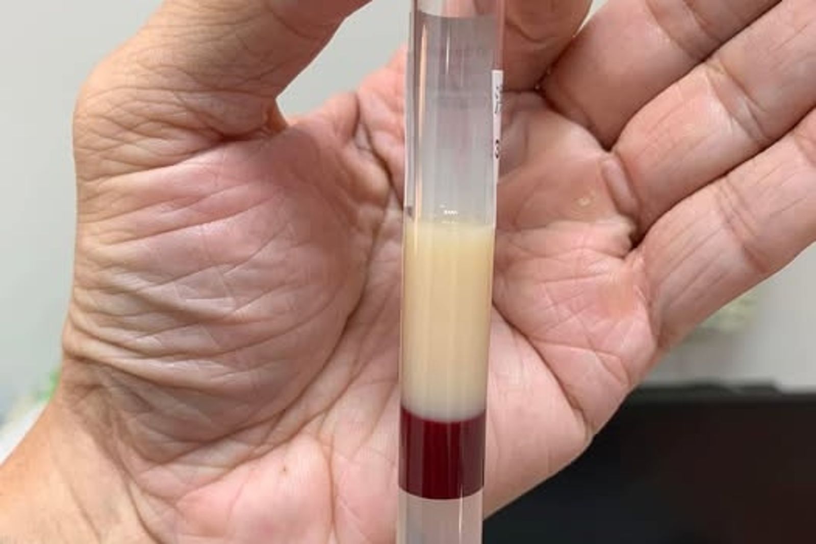 該名病患油脂為血液2倍。圖/Icu醫生陳志金