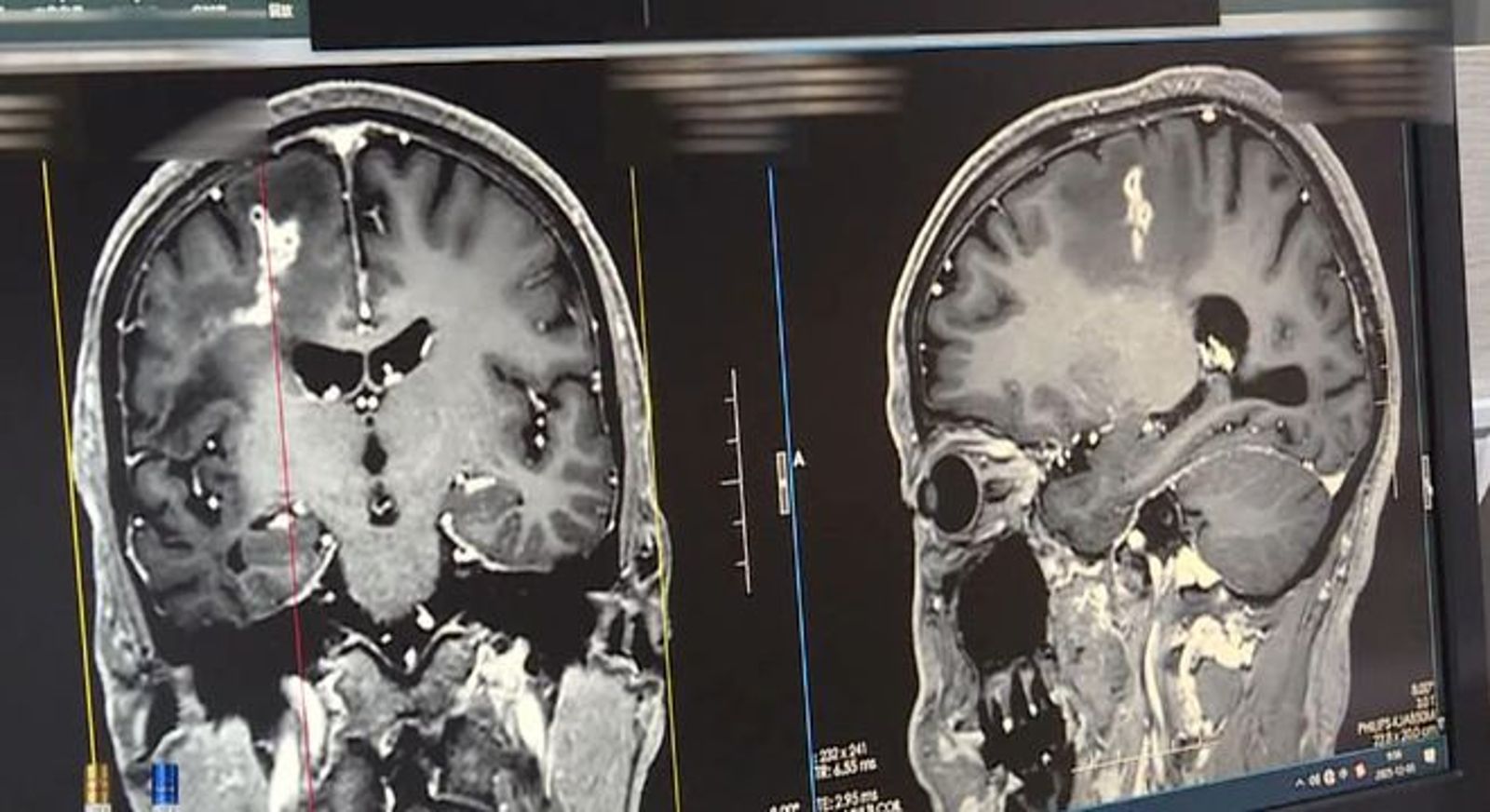 他癲癇21年不敢出門竟是「腦中藏10公分寄生蟲」　醫揭入侵途徑